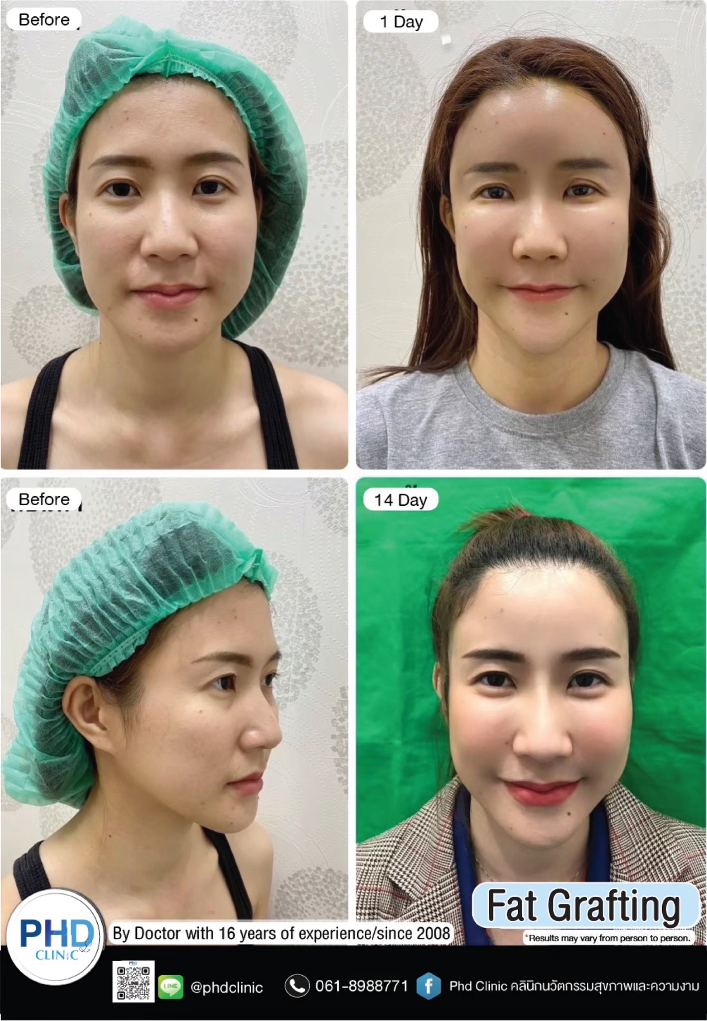 Fat Grafting Phuket