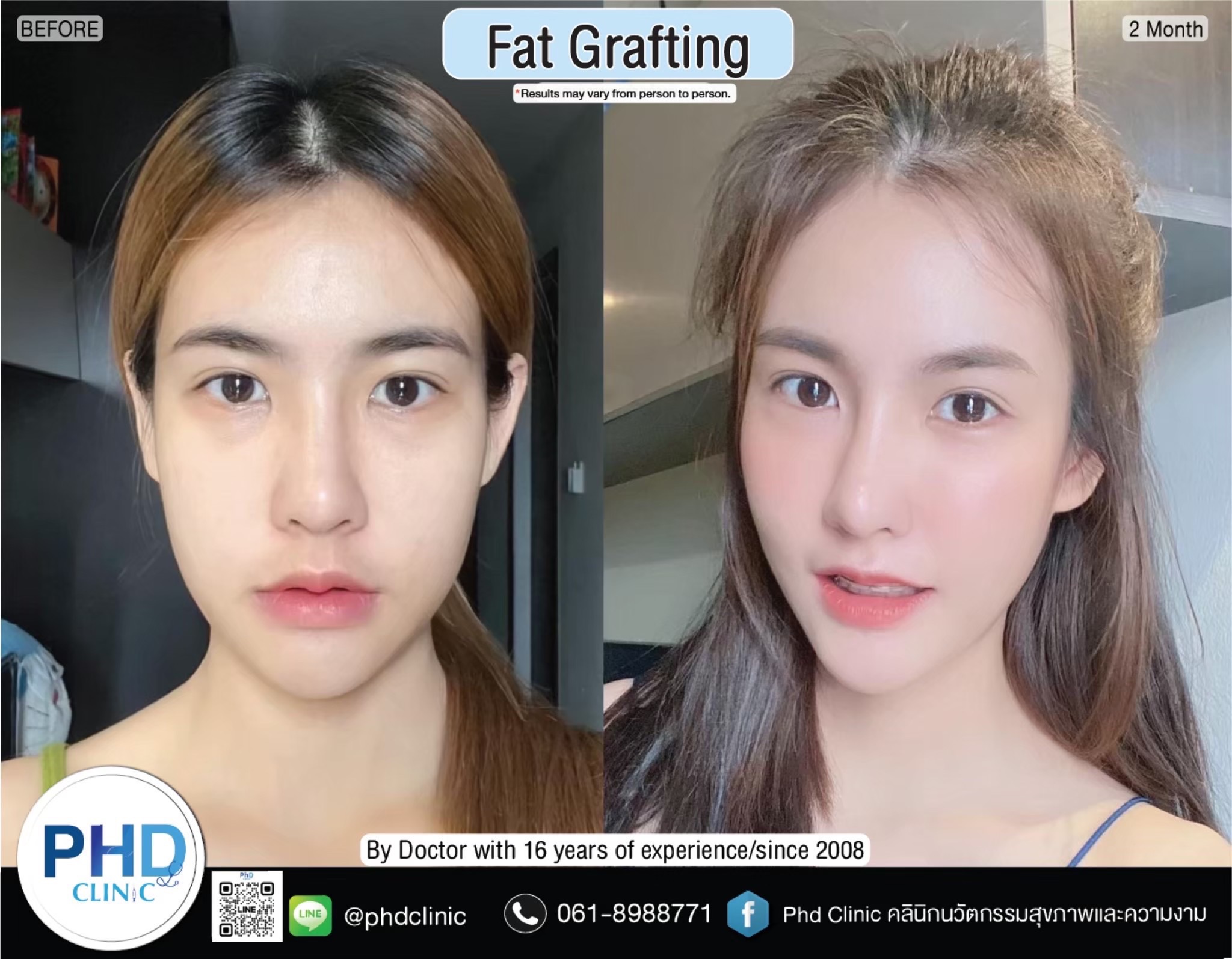 Fat Grafting Phuket