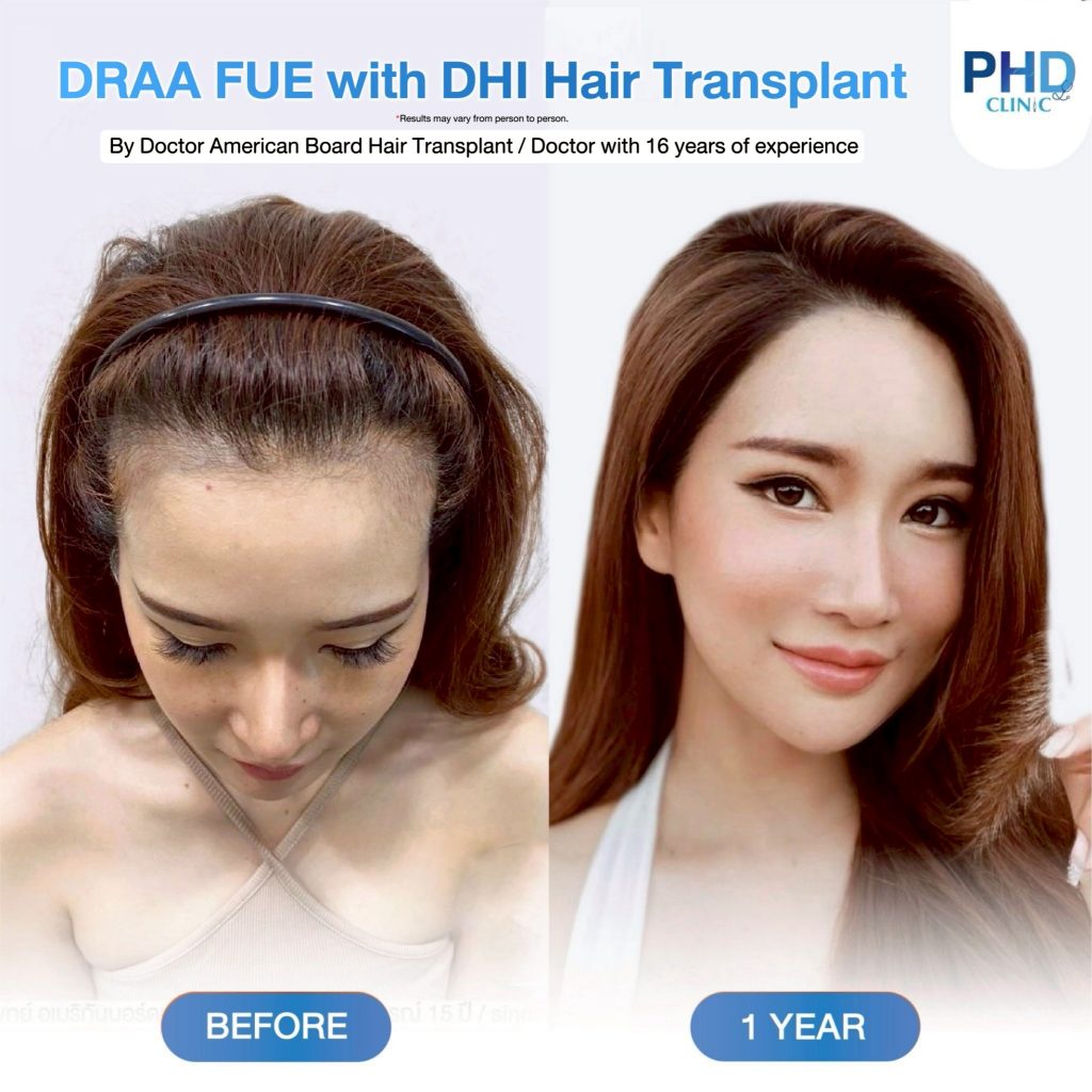 ABHRS hair transplant Thailand