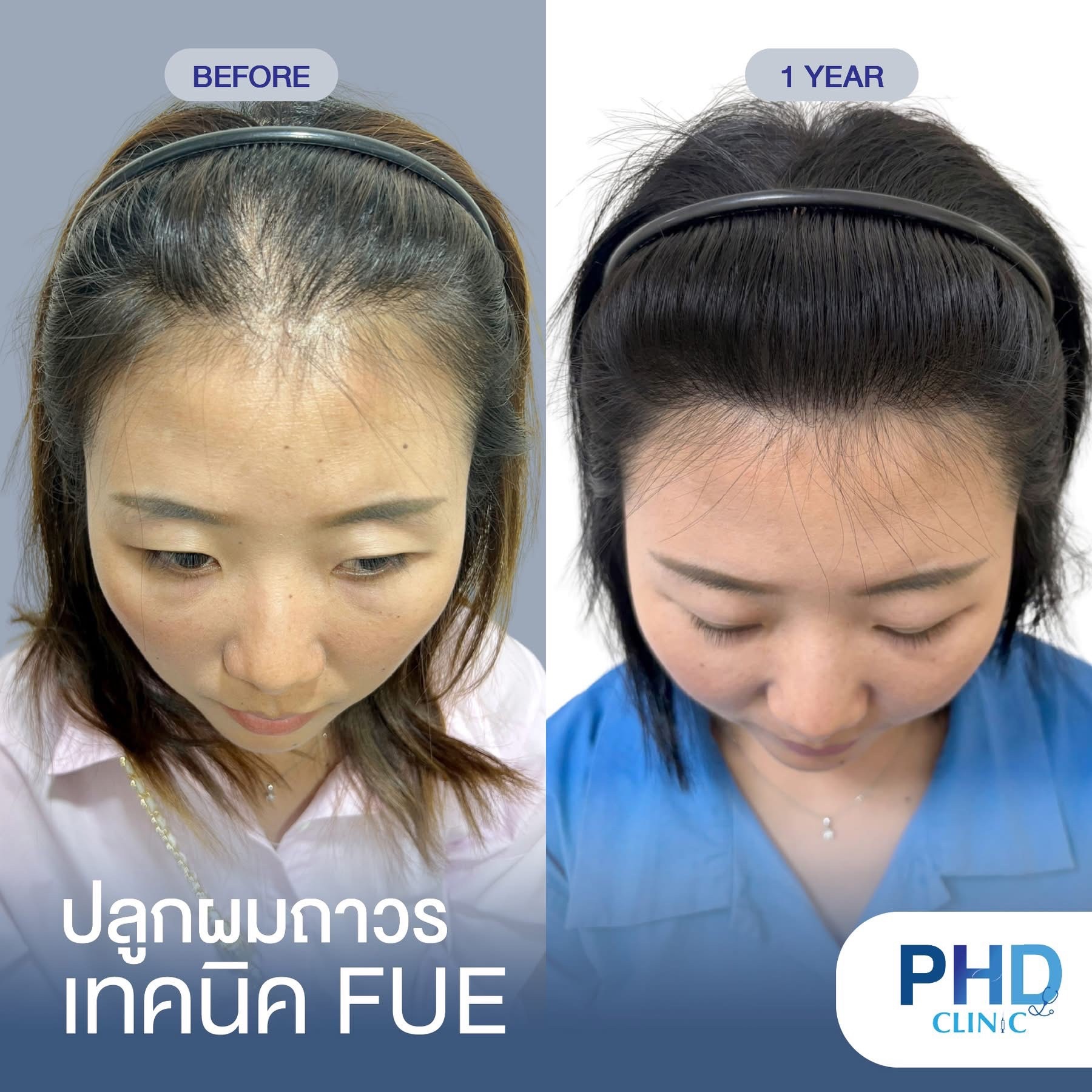 ABHRS hair transplant Thailand