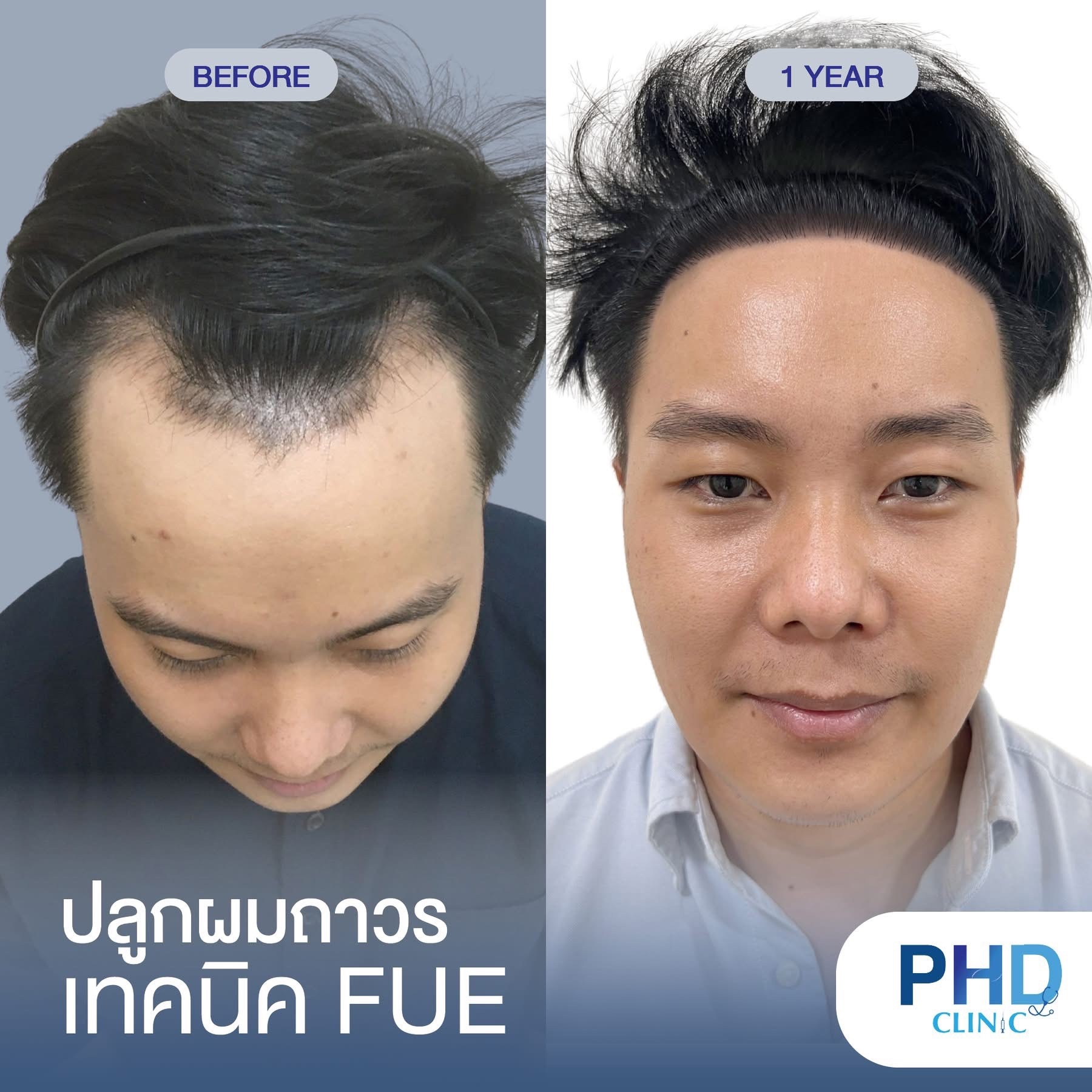 ABHRS hair transplant Thailand