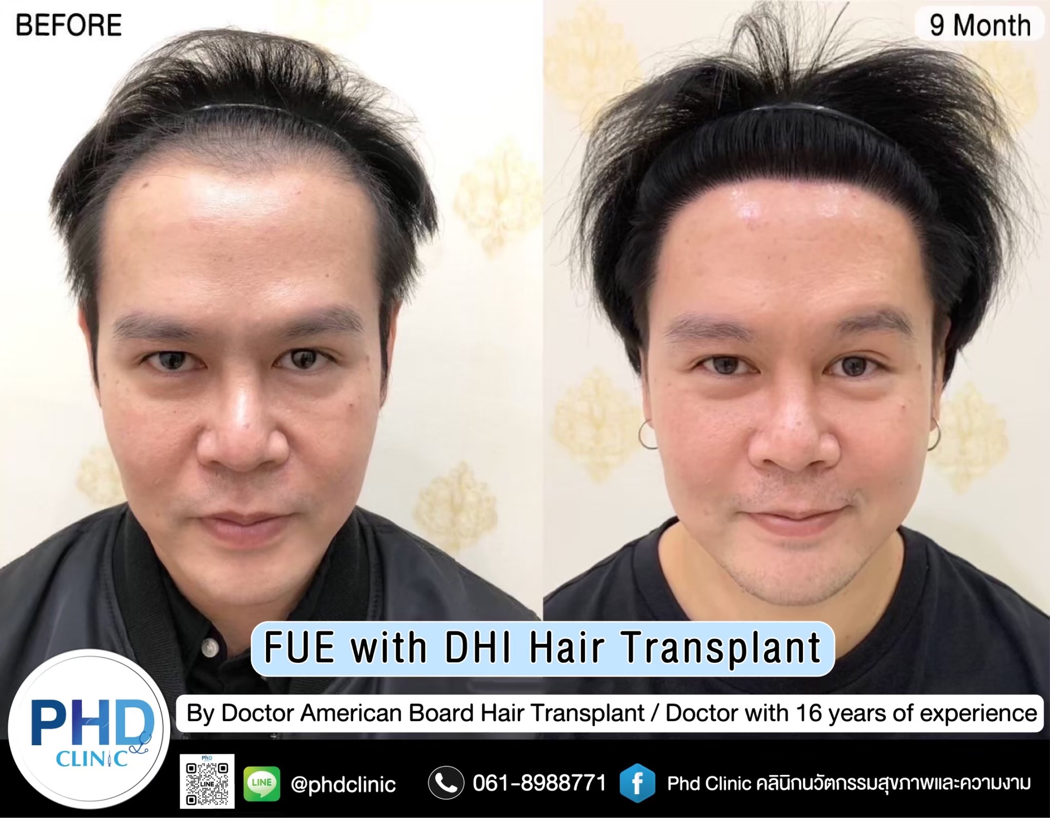 ABHRS hair transplant Thailand