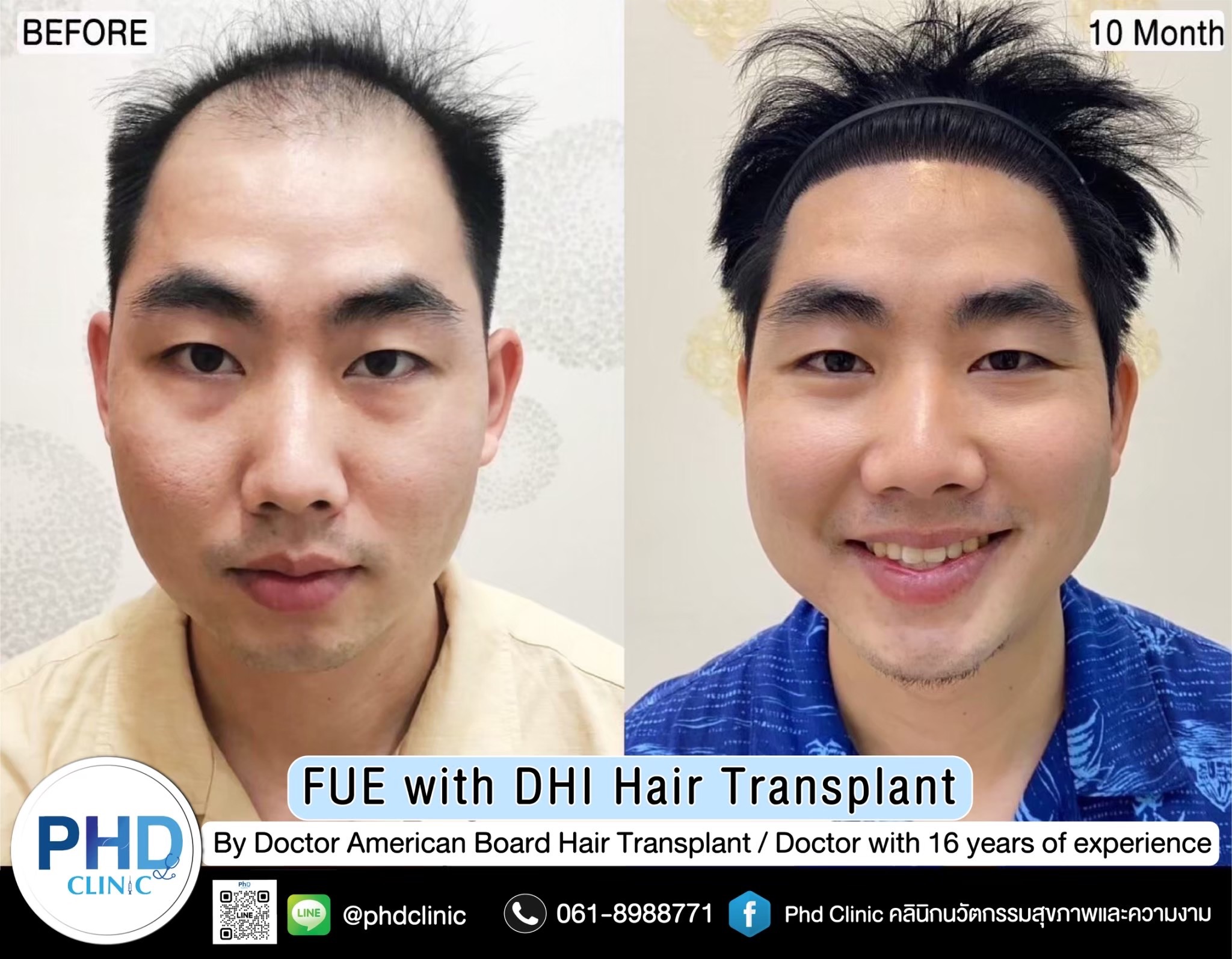 ABHRS hair transplant Thailand