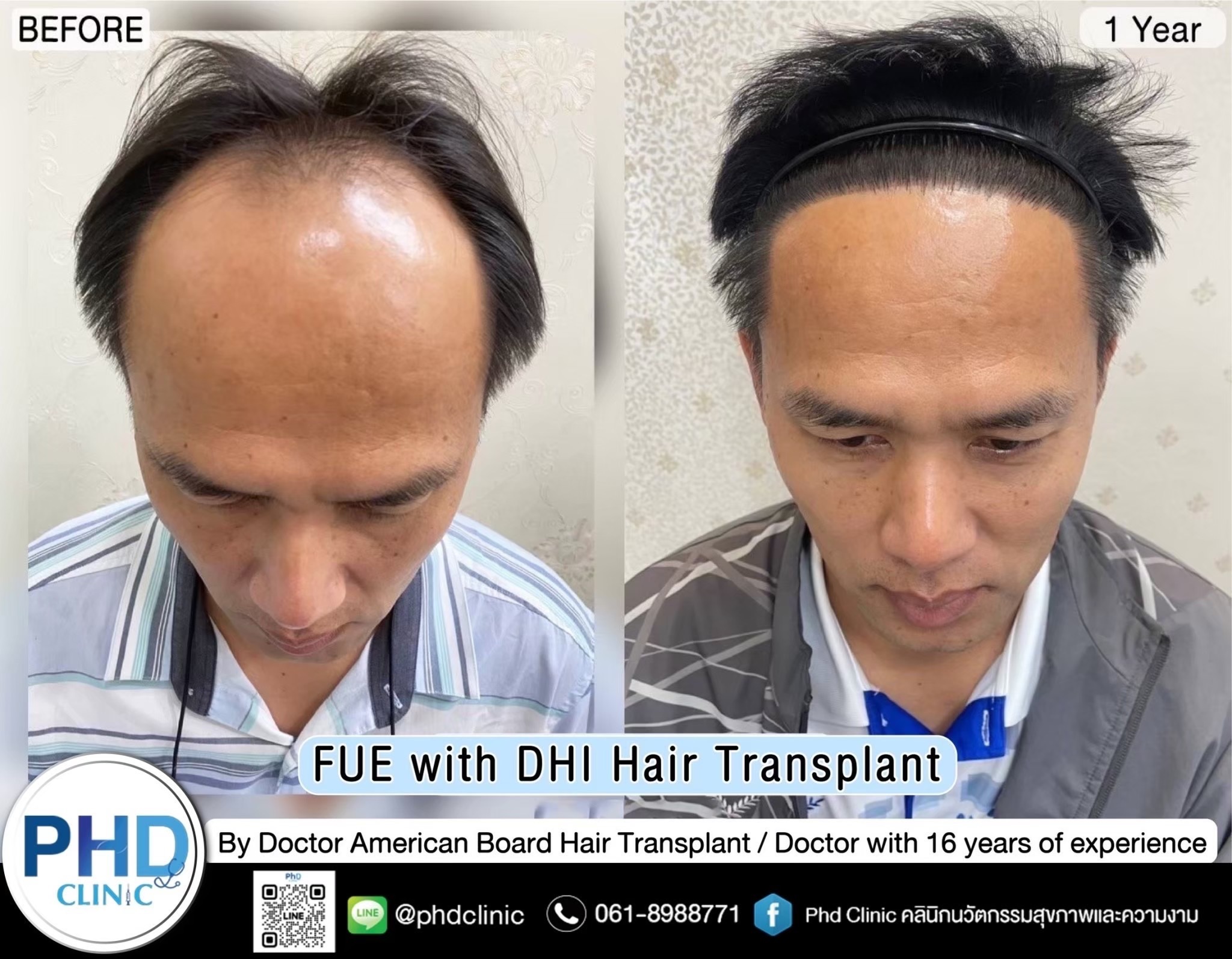 ABHRS hair transplant Thailand
