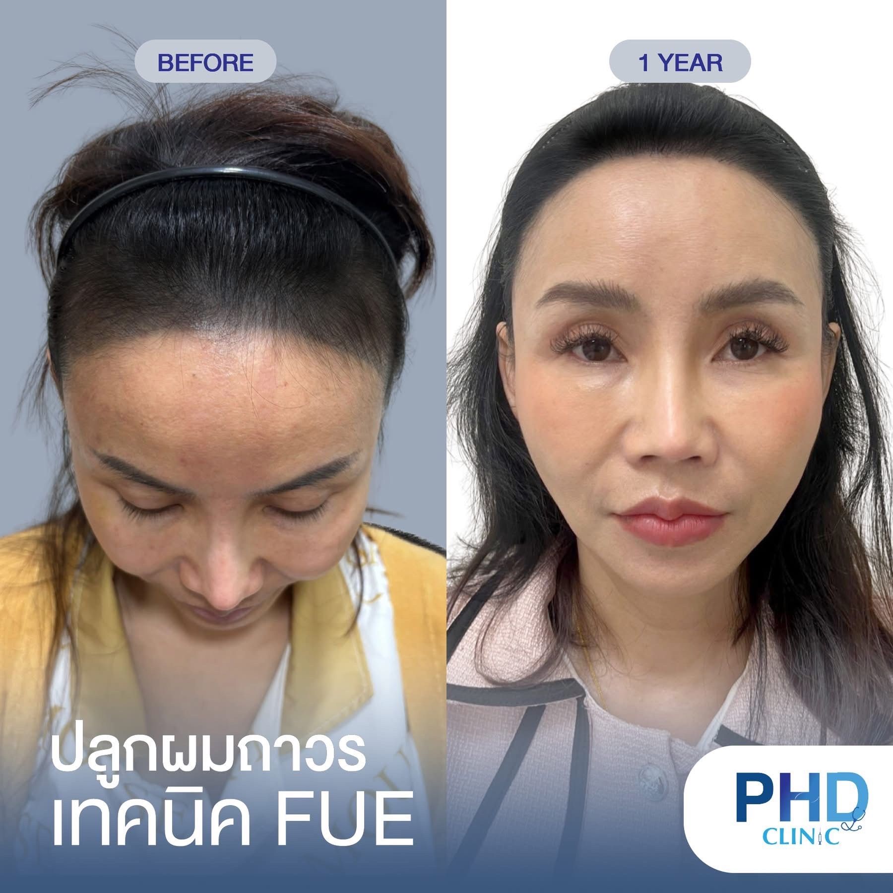 ABHRS hair transplant Thailand