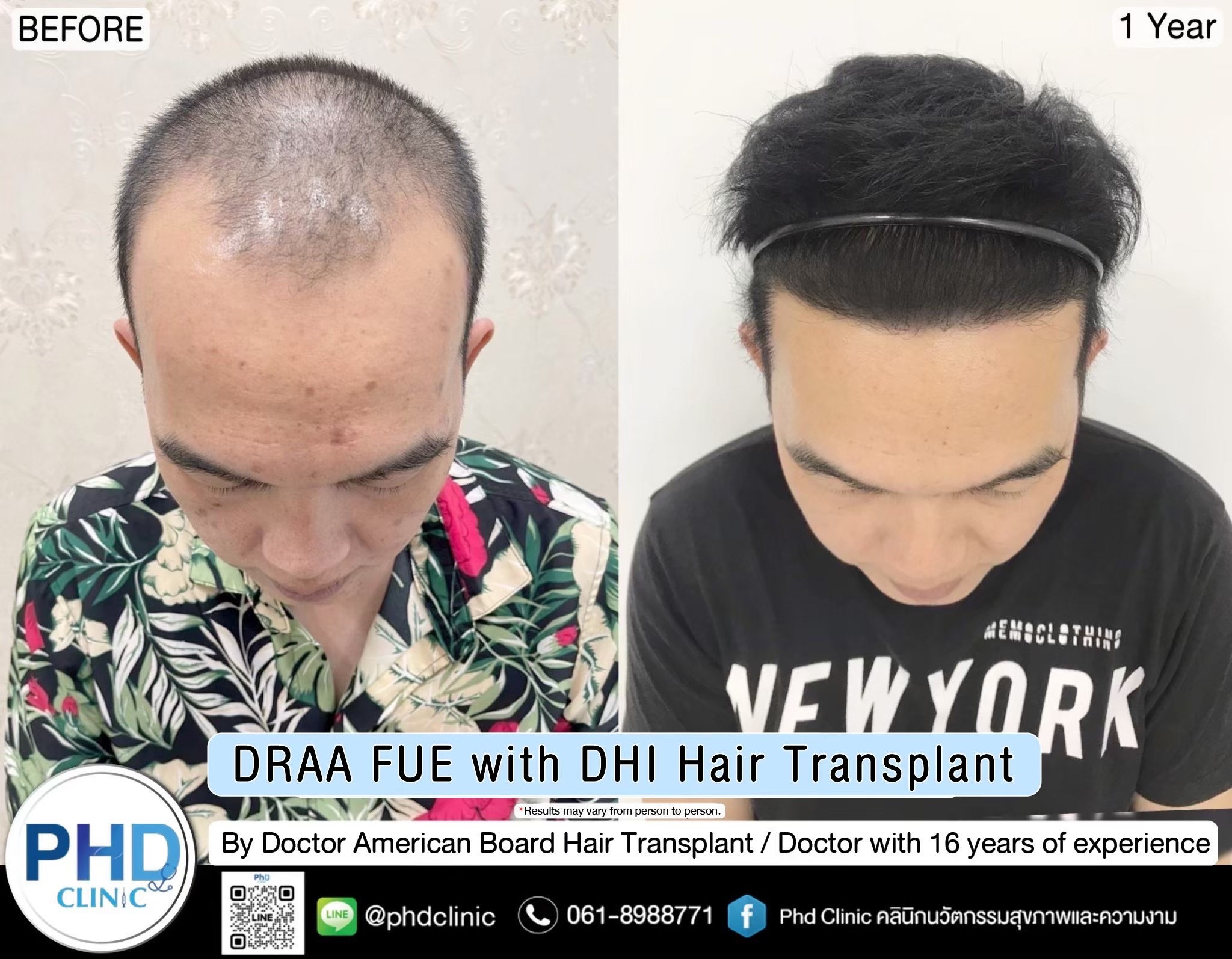 ABHRS hair transplant Thailand