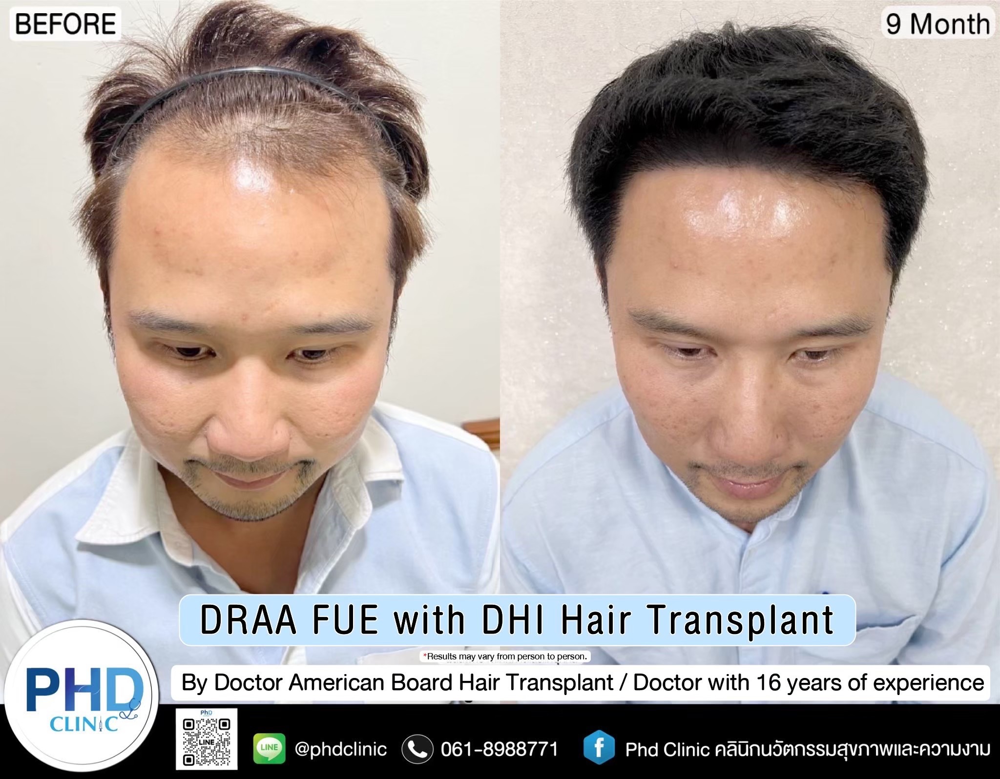 ABHRS hair transplant Thailand