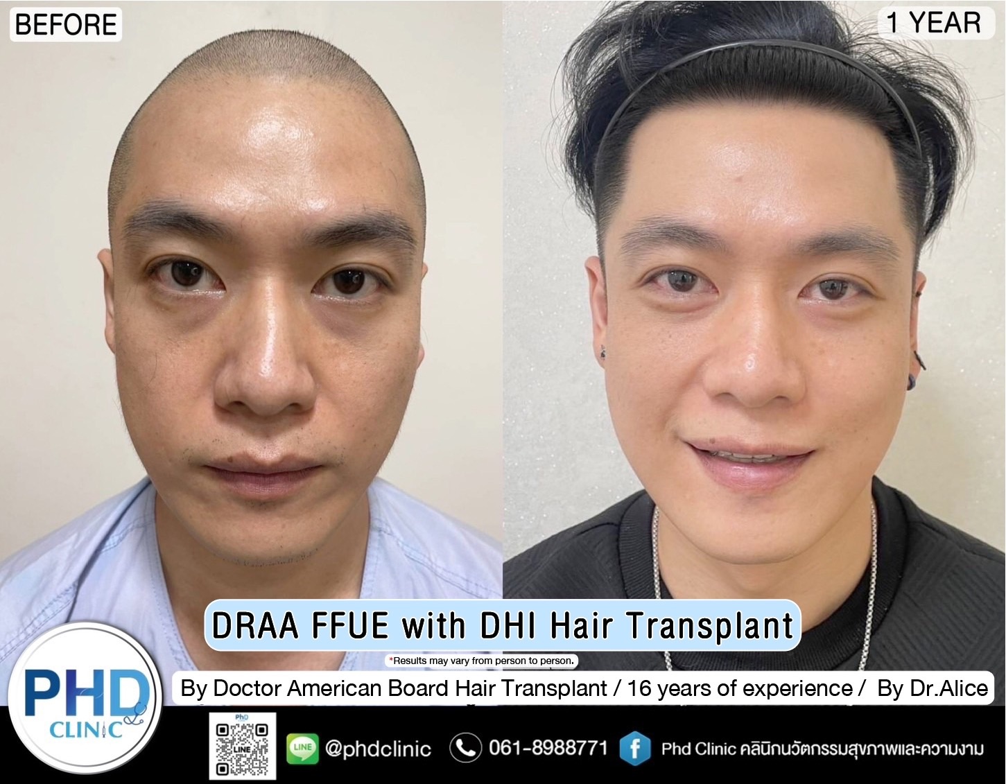 ABHRS hair transplant Thailand