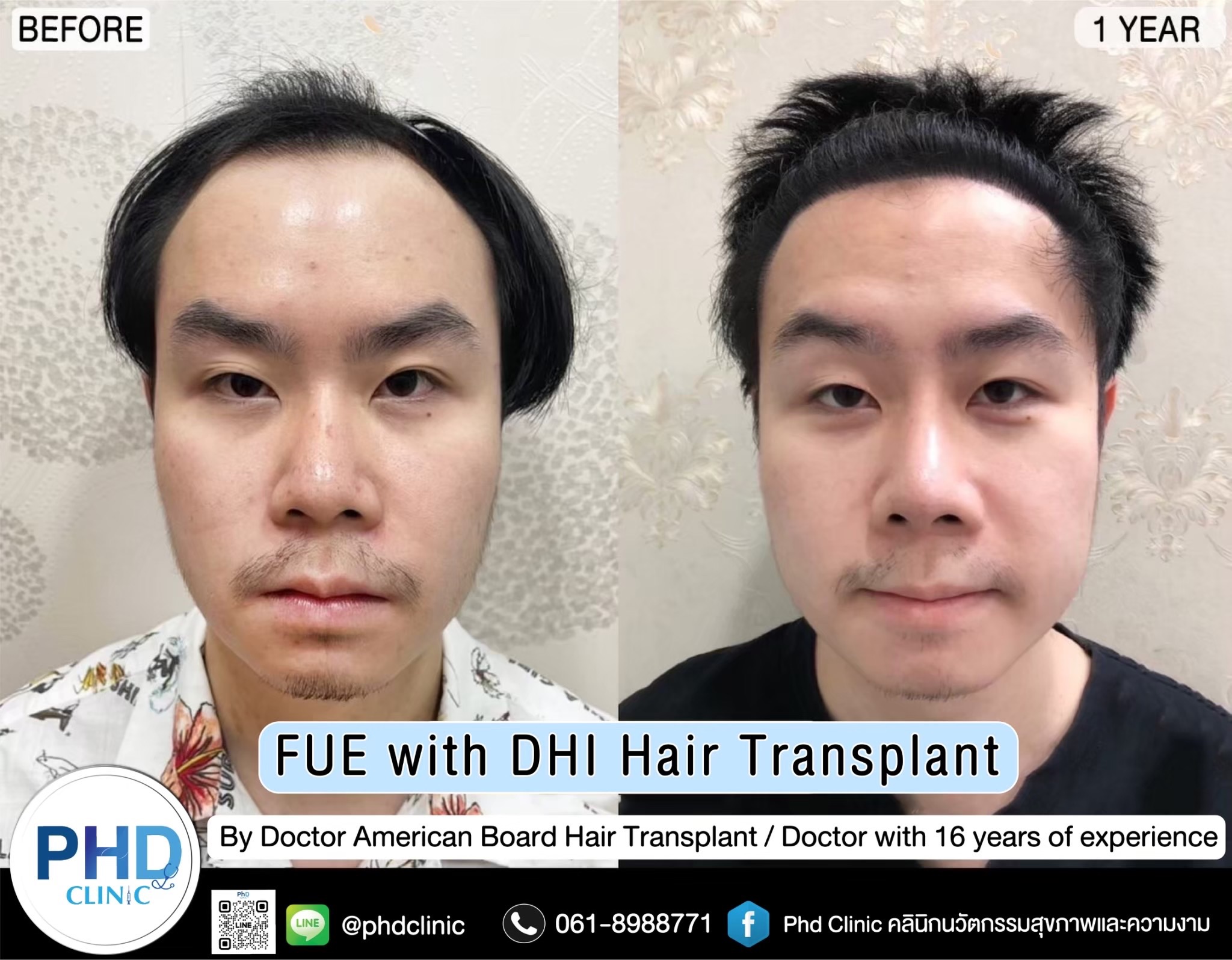 ABHRS hair transplant Thailand