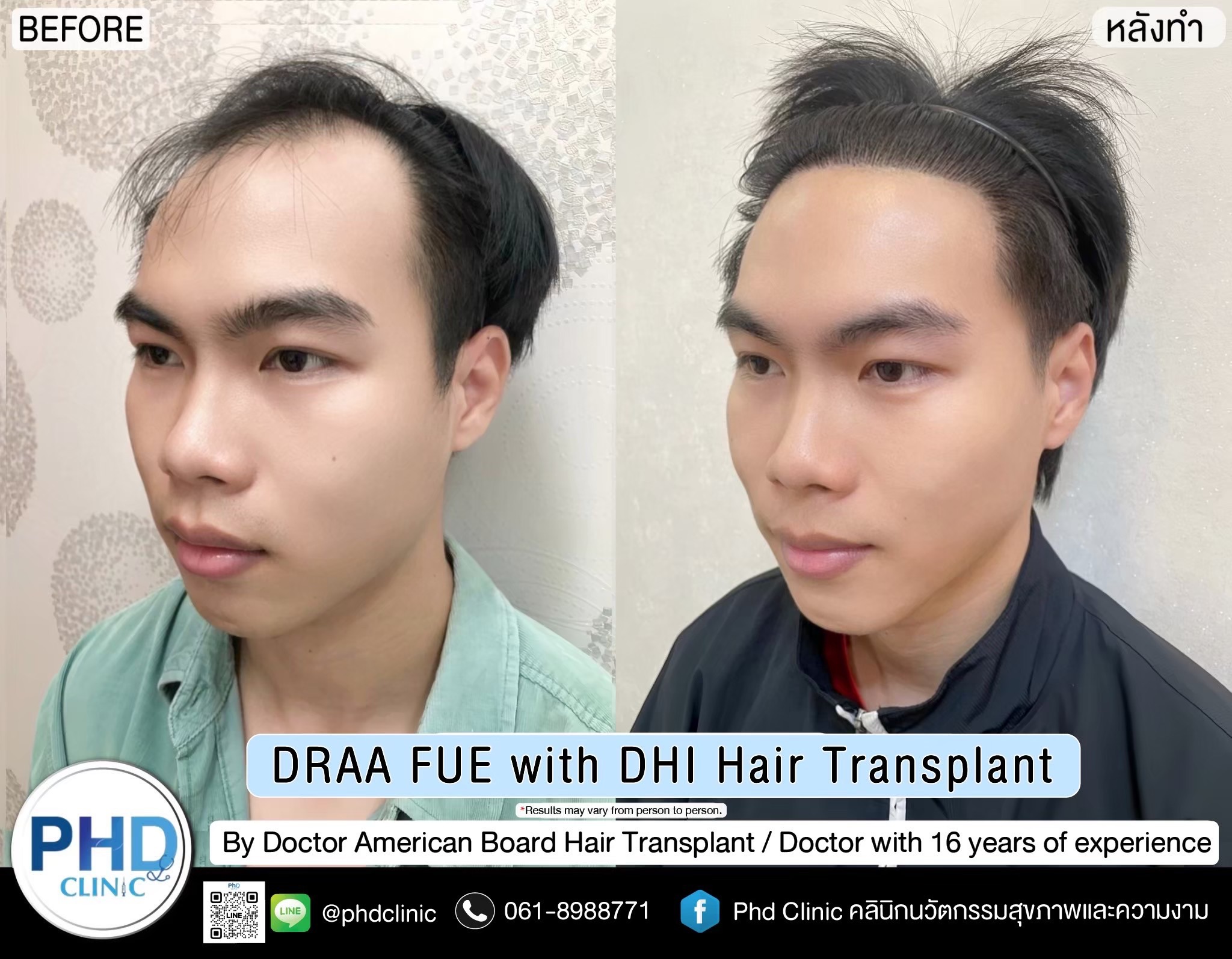 ABHRS hair transplant Thailand