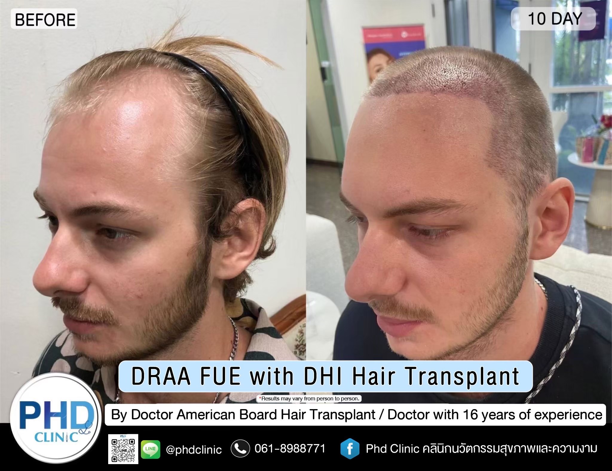 ABHRS hair transplant Thailand