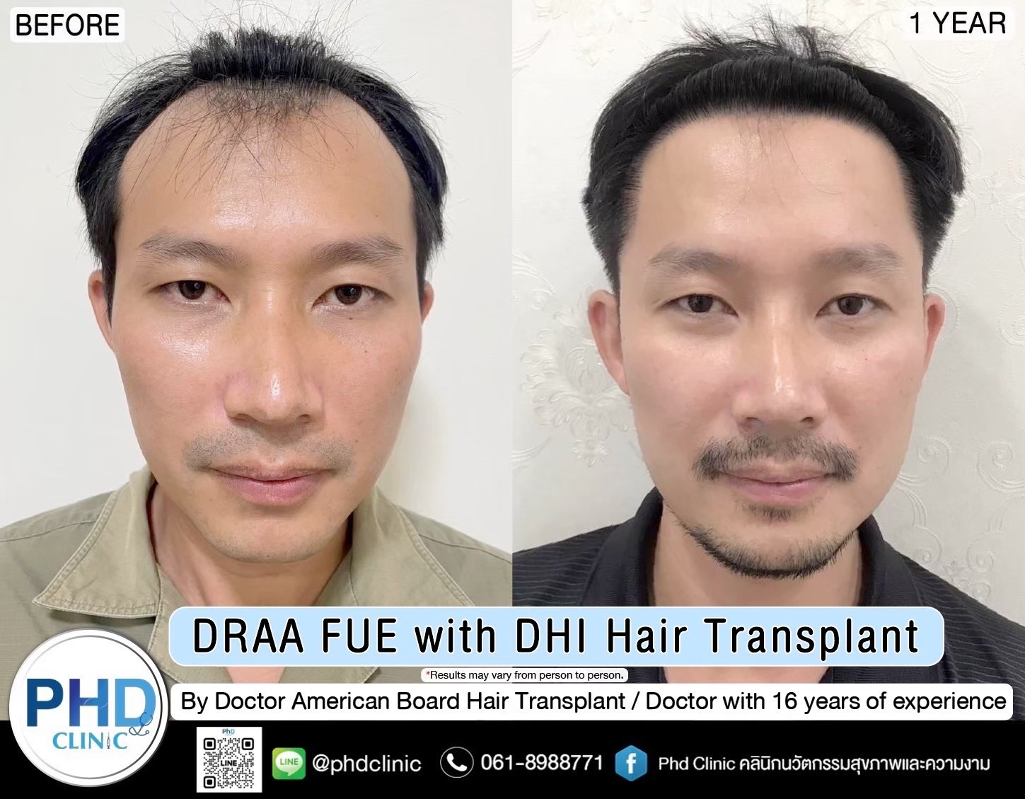 ABHRS hair transplant Thailand