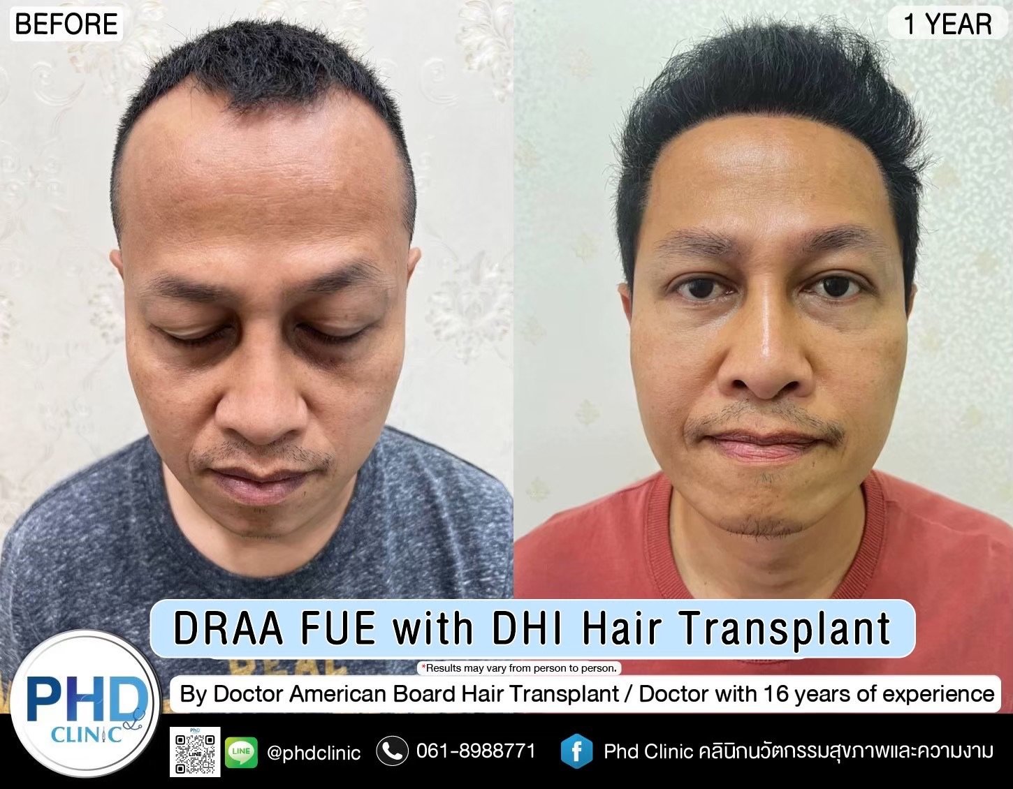 ABHRS hair transplant Thailand