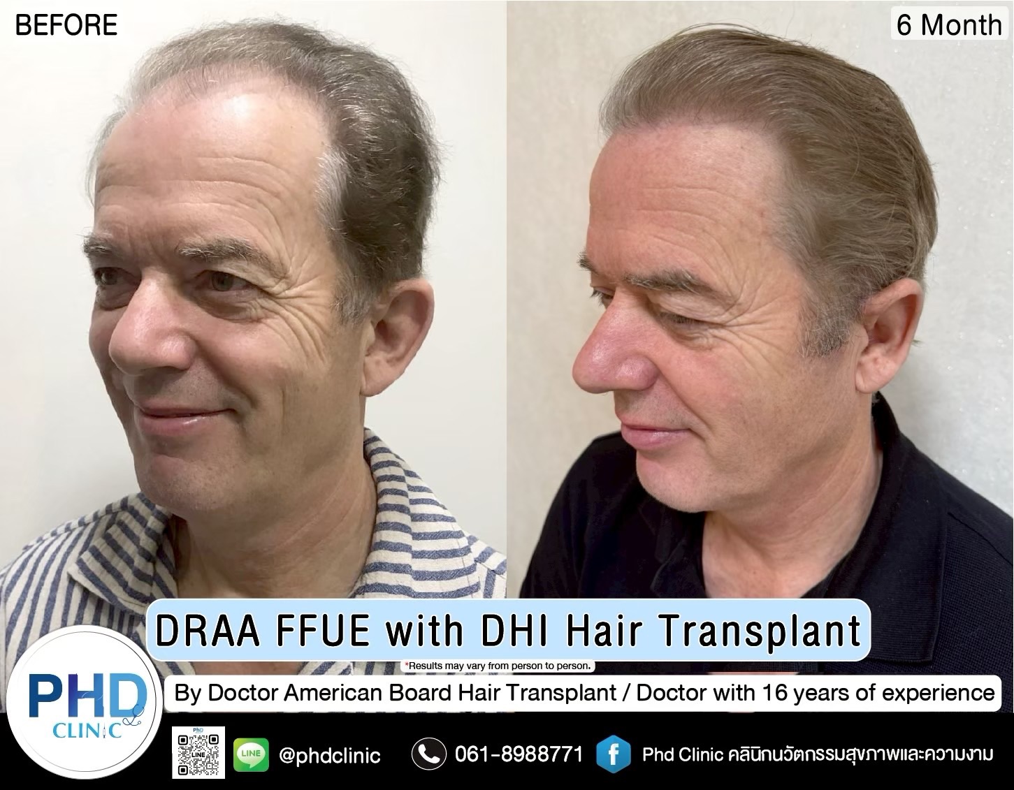 ABHRS hair transplant Thailand
