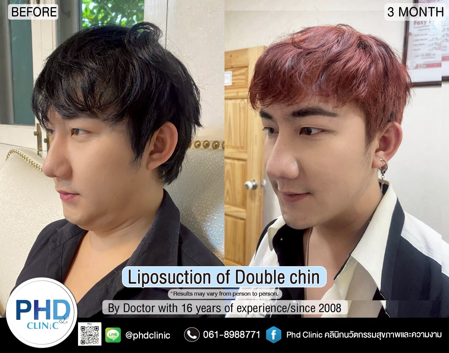 ABHRS hair transplant Thailand