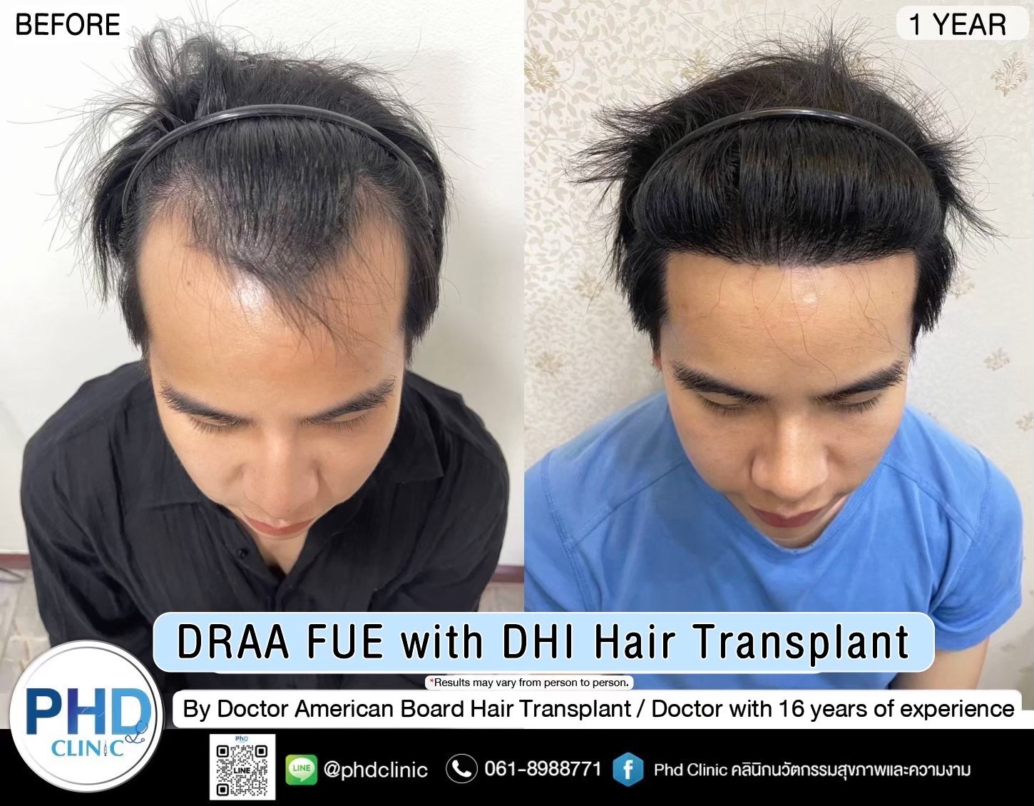 ABHRS hair transplant Thailand