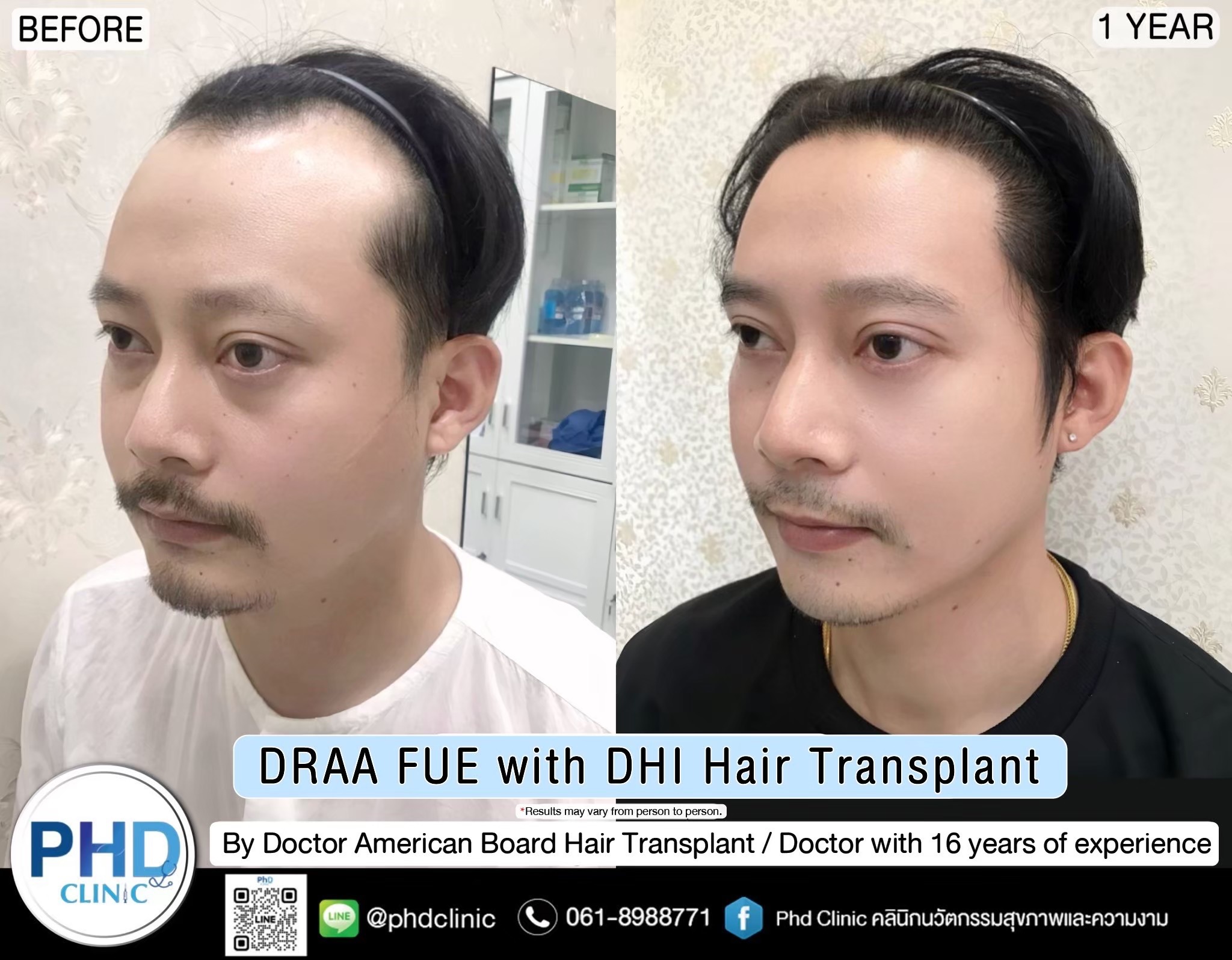 ABHRS hair transplant Thailand