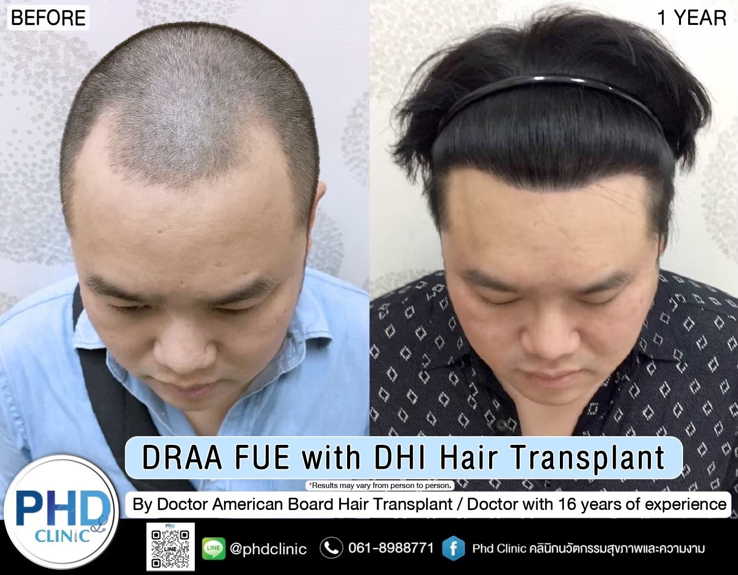 ABHRS hair transplant Thailand