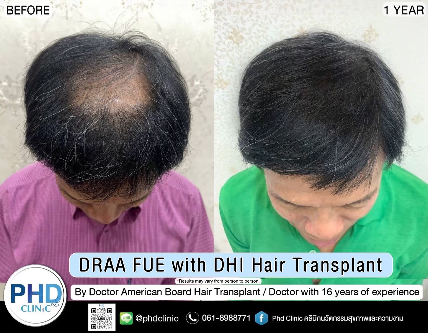 ABHRS hair transplant Thailand