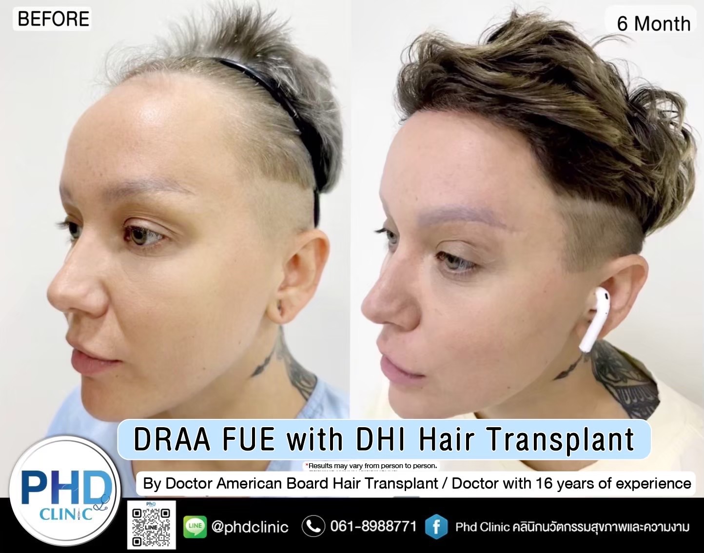 ABHRS hair transplant Thailand