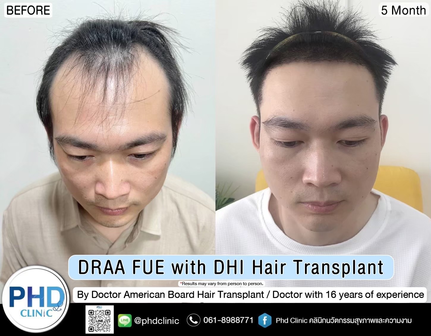 ABHRS hair transplant Thailand ABHRS hair transplant Thailand