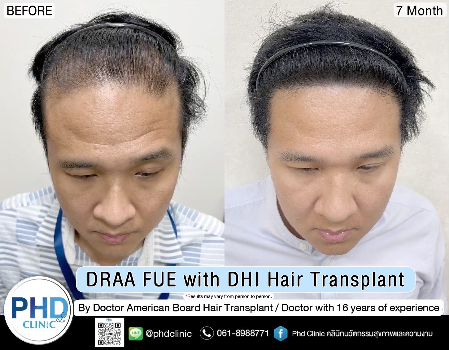 ABHRS hair transplant Thailand