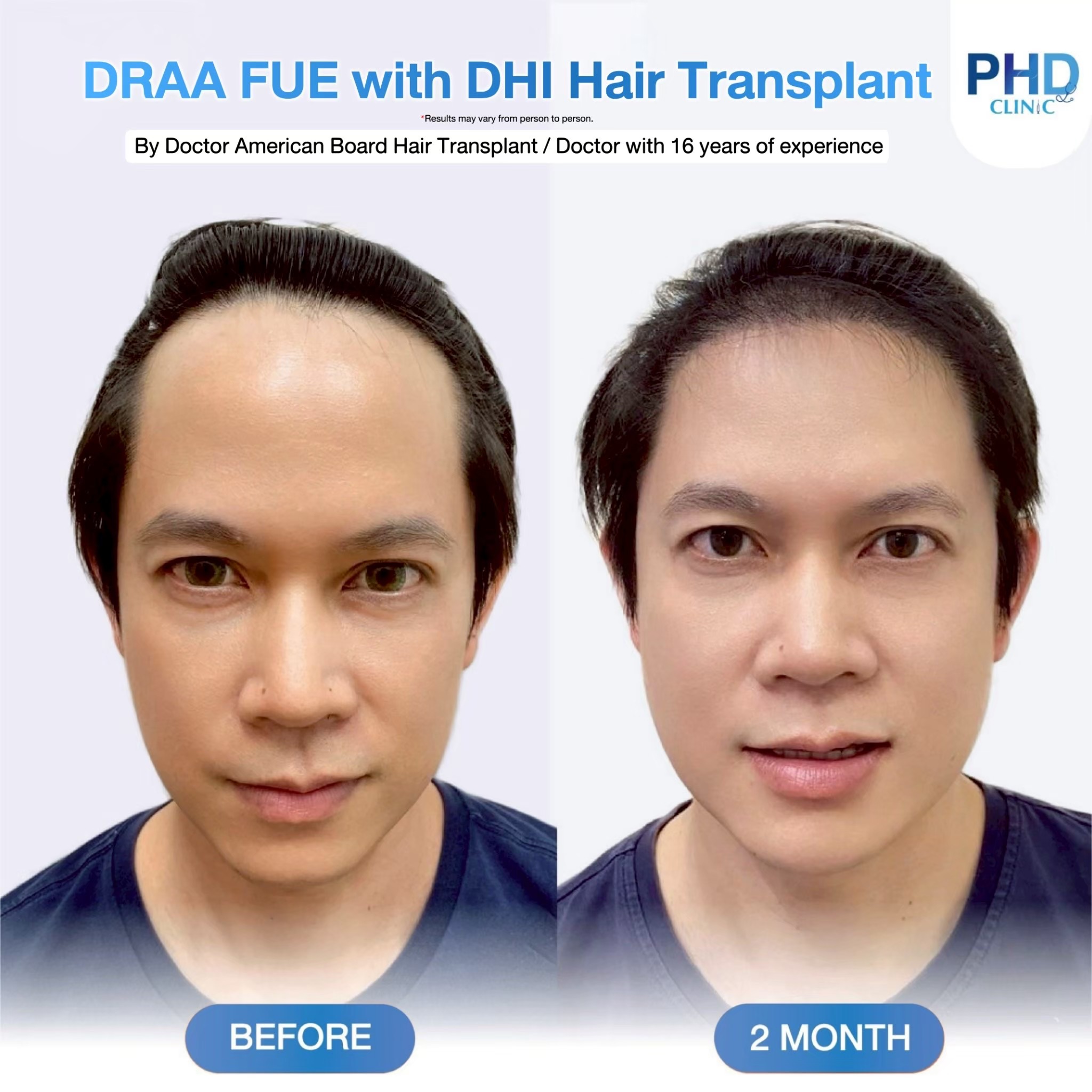 Hair Transplant