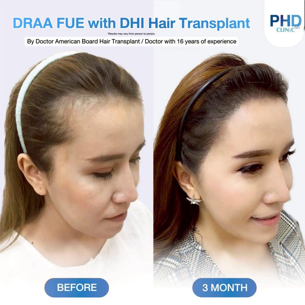 Hair Transplant