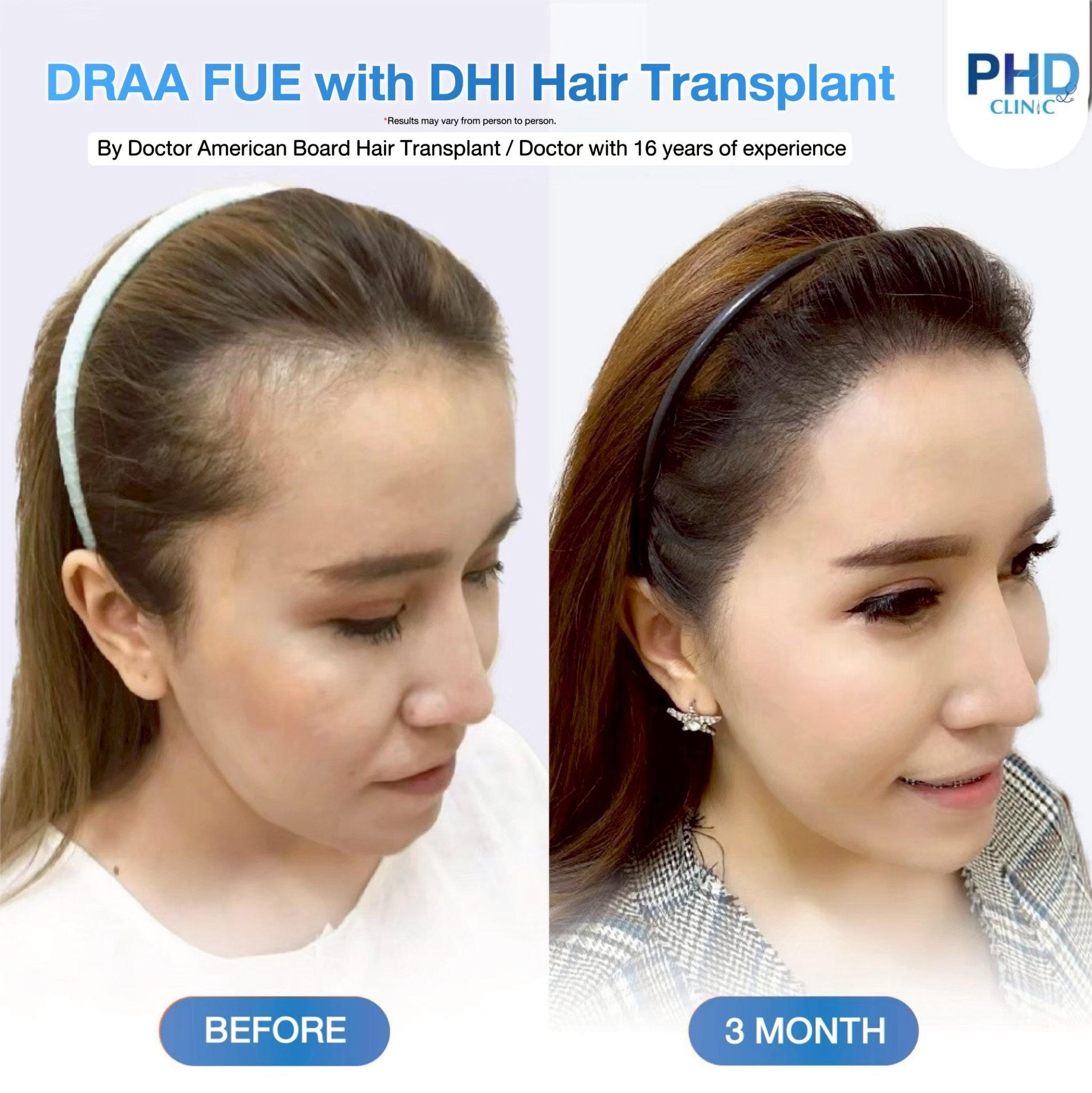 Hair Transplant