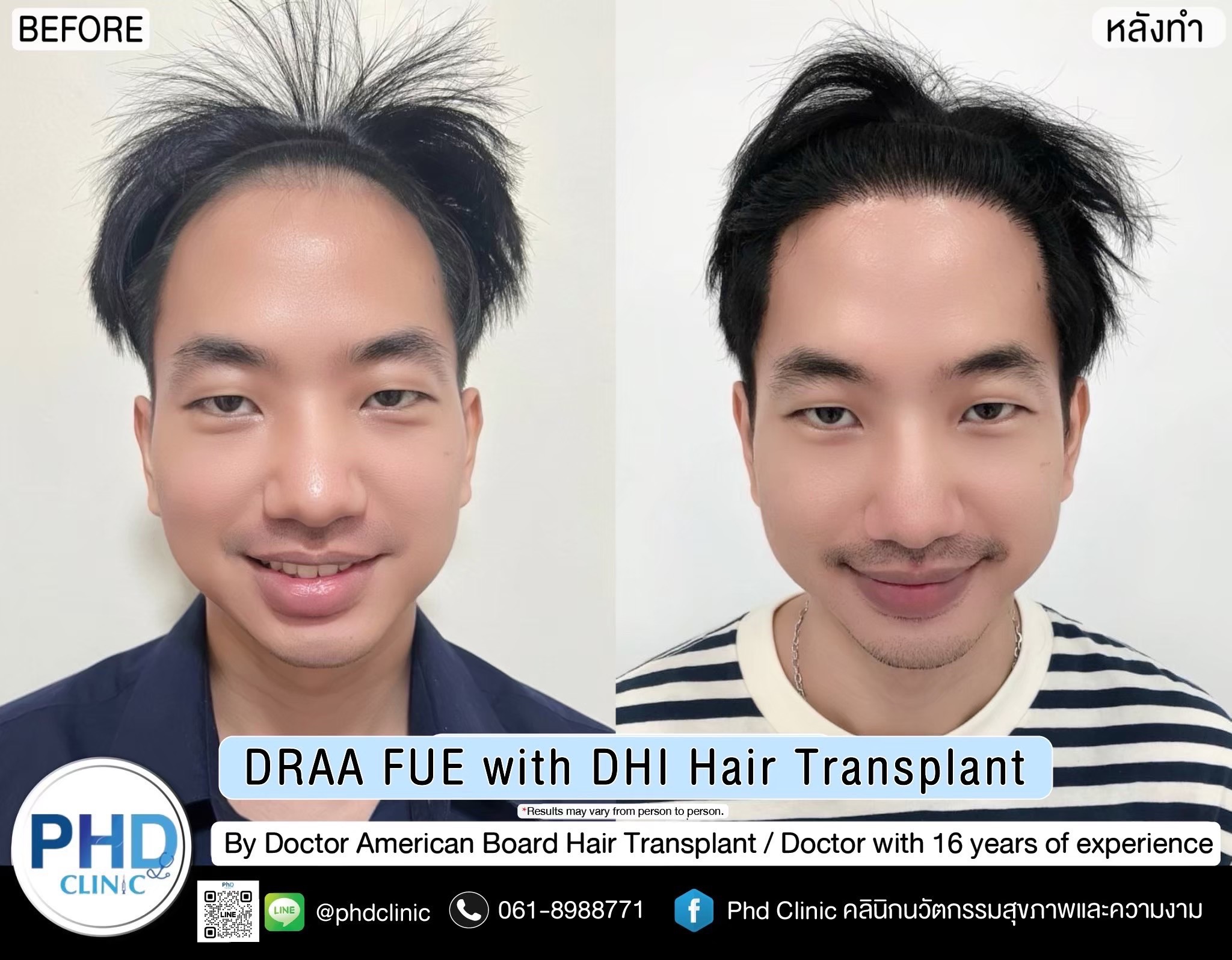 Hair transplant Bangkok