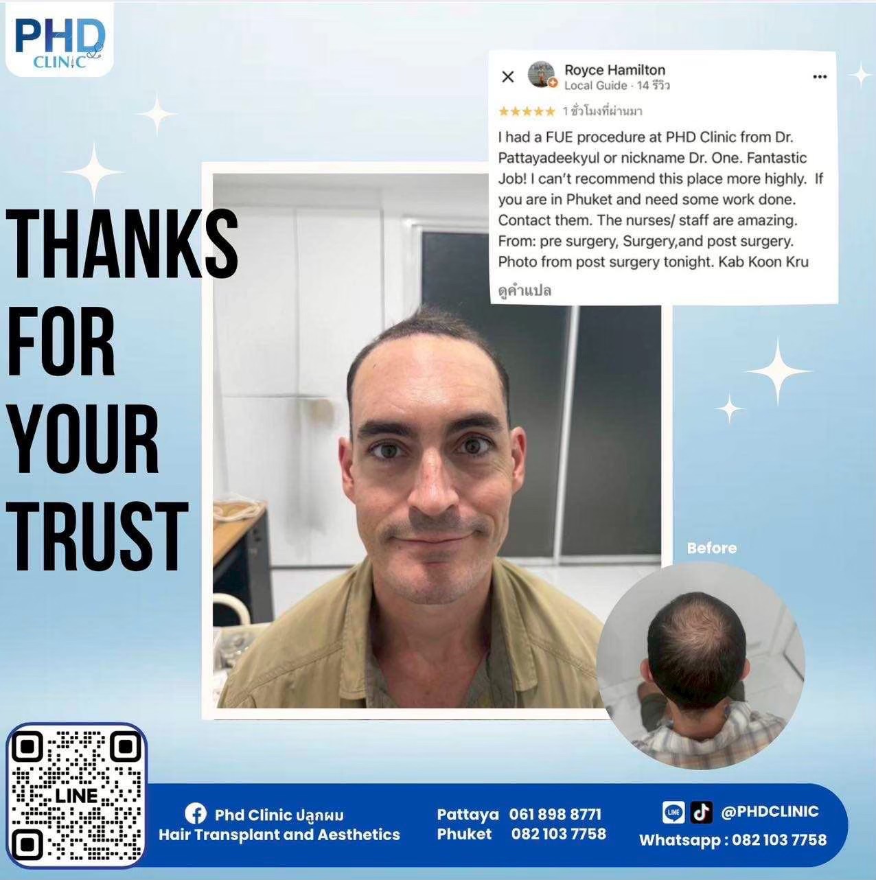 Hair transplant Bangkok