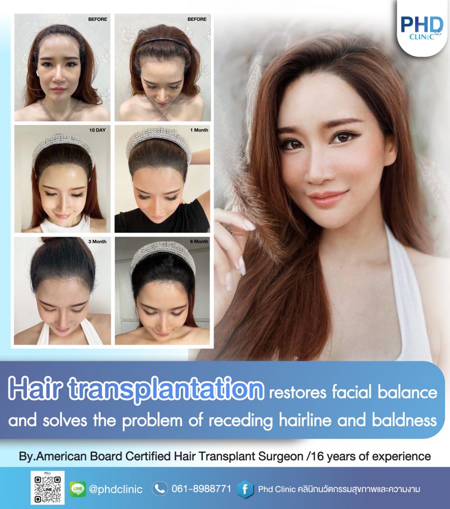 Hair transplant Bangkok