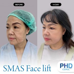 Facelift Surgery Phuket