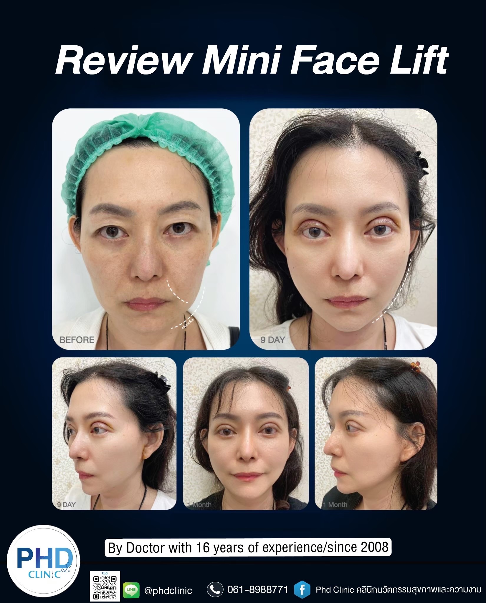Facelift Surgery Phuket