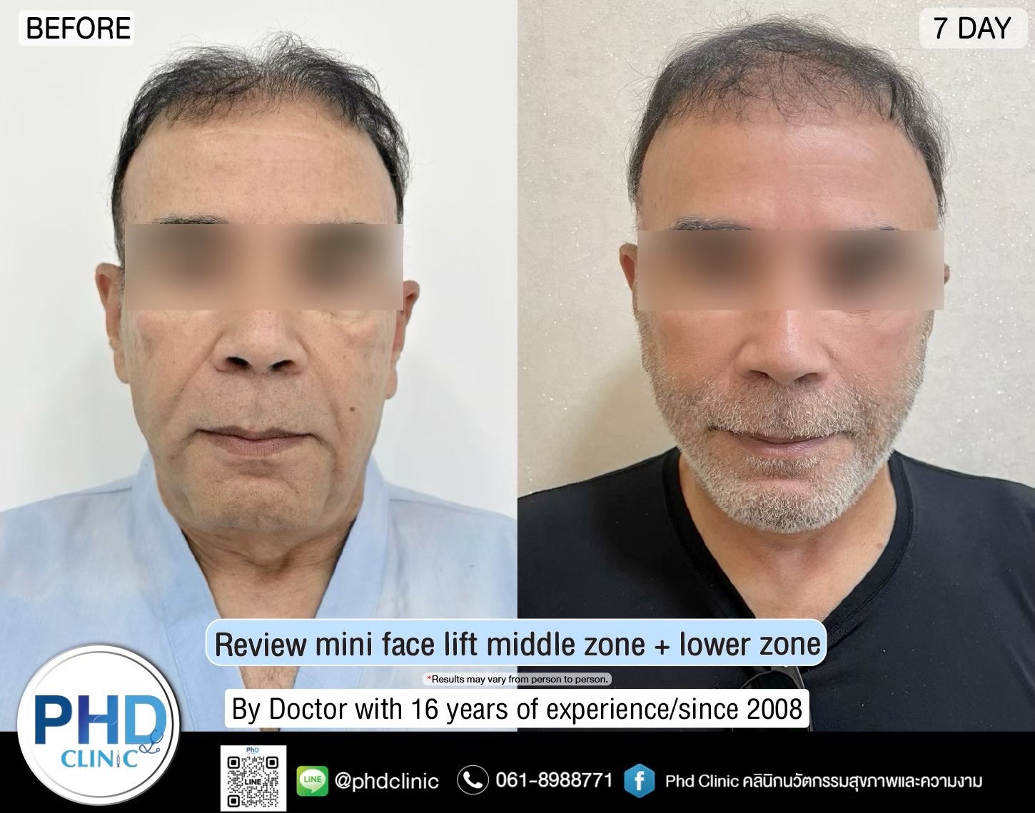 review Facelift Surgery Phuket