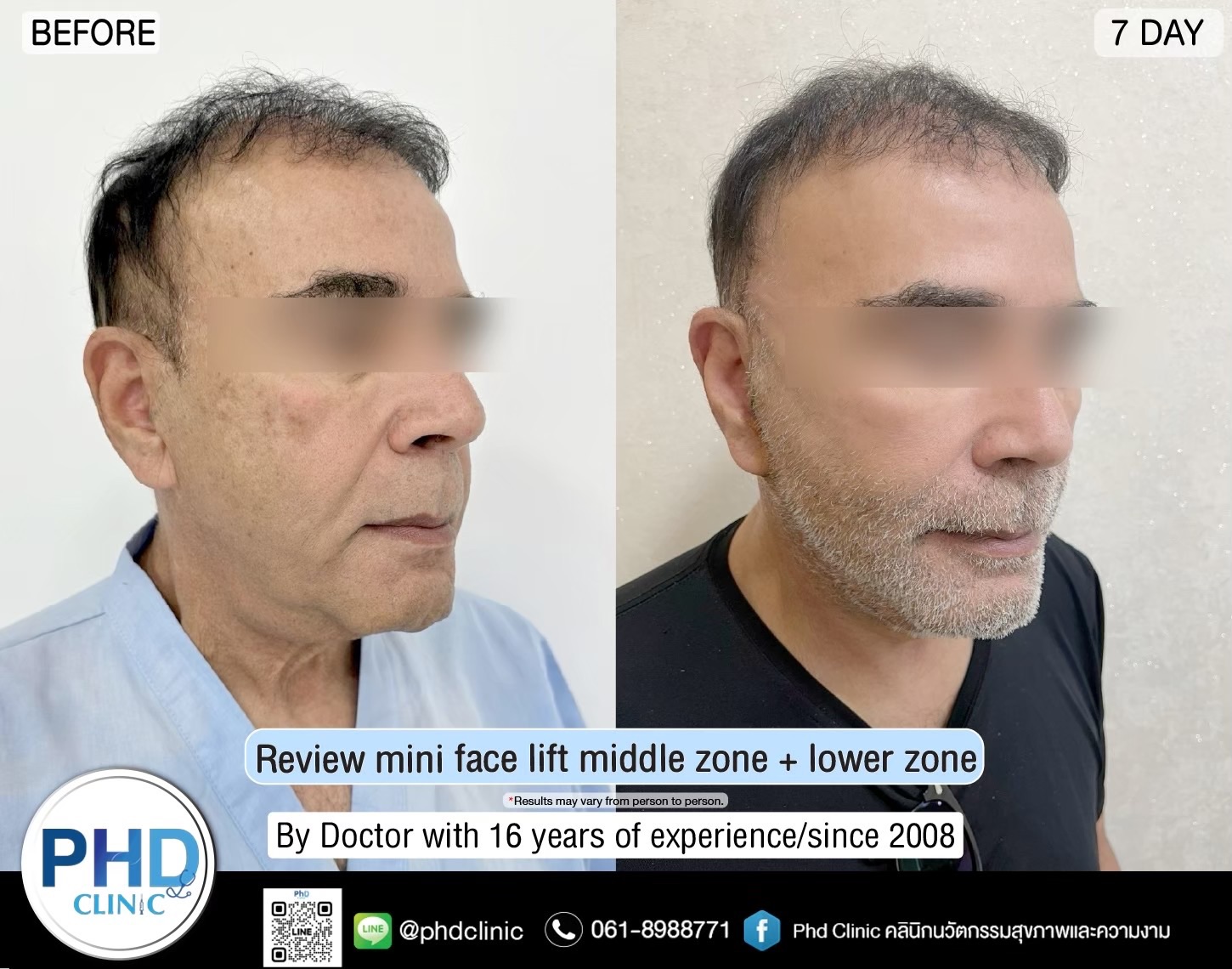 review Facelift Surgery Phuket