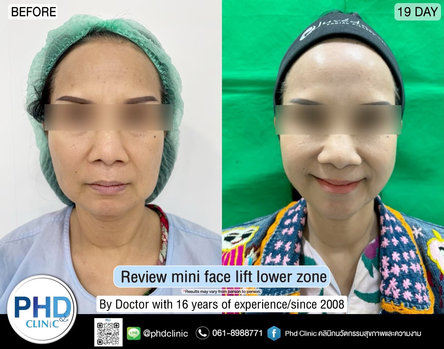 review Facelift Surgery Phuket 2026