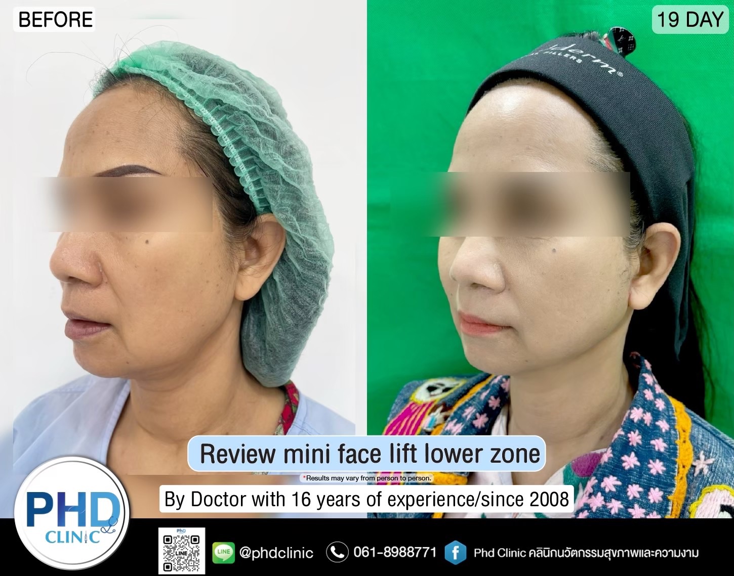 review Facelift Surgery Phuket 2026