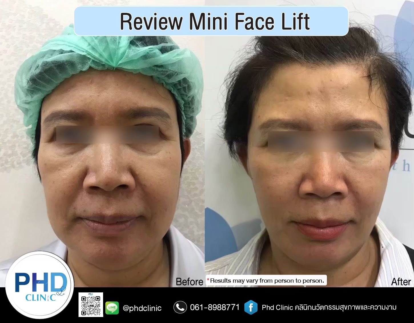review Facelift Surgery Phuket 2026