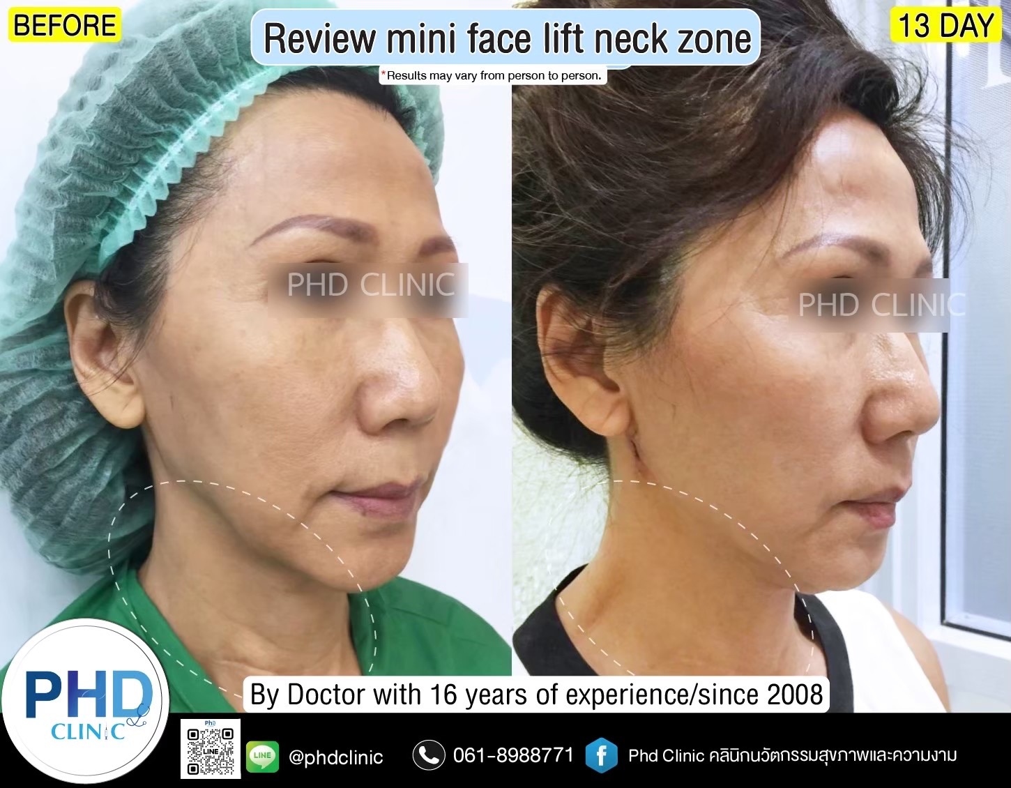review Facelift Surgery Phuket 2026