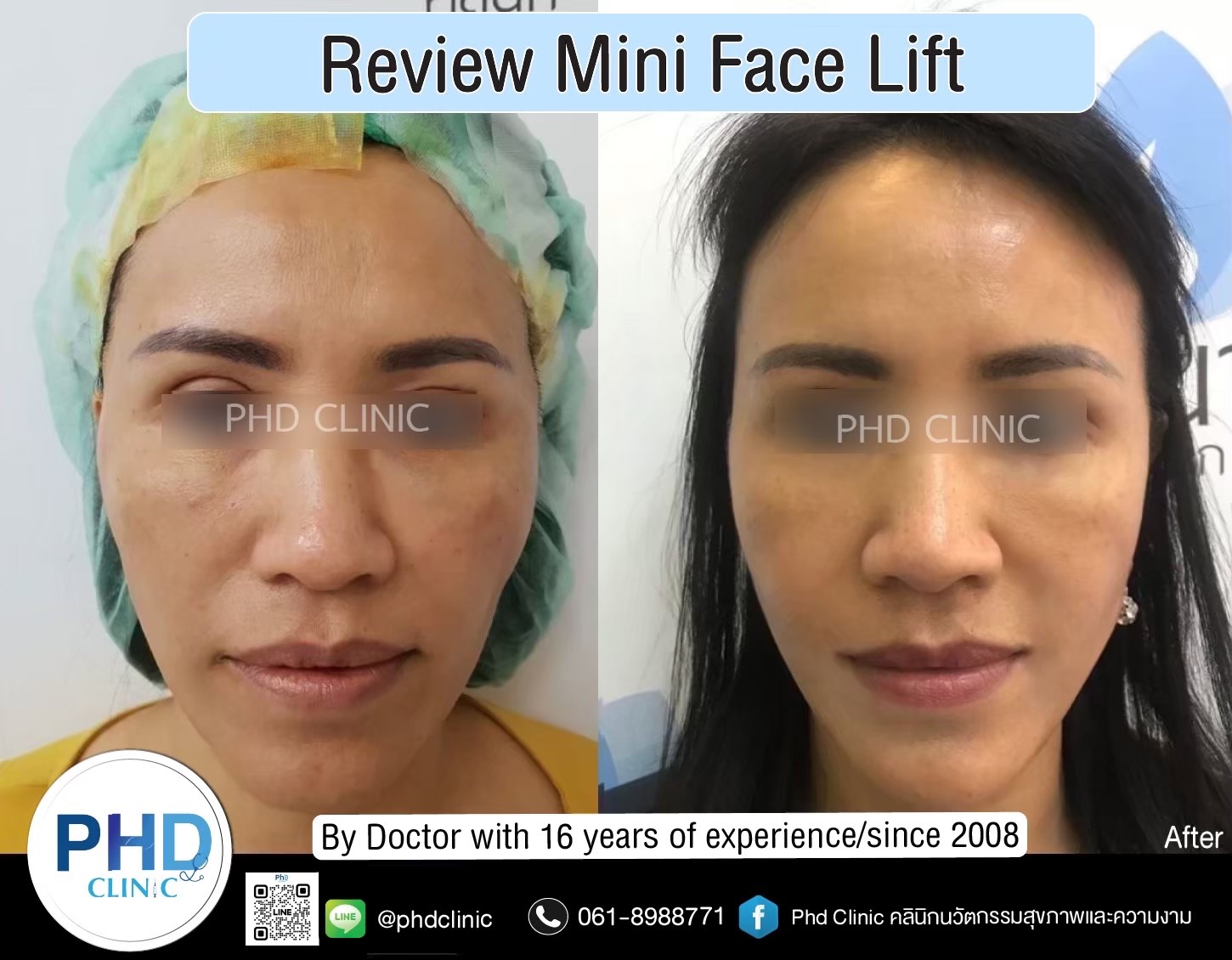 review Facelift Surgery Phuket 2026