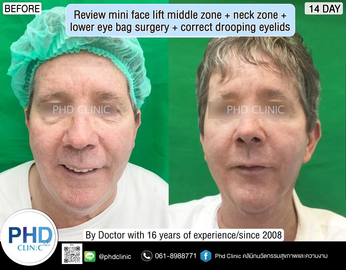 review Facelift Surgery Phuket 2026