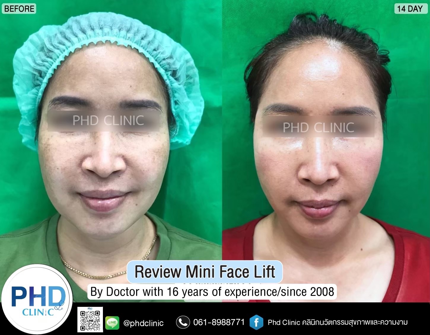 review Facelift Surgery Phuket