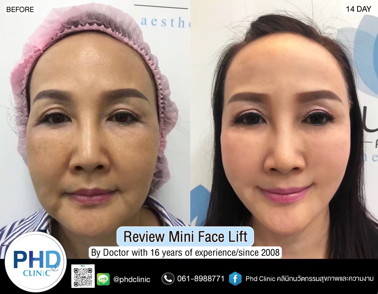 review Facelift Surgery Phuket