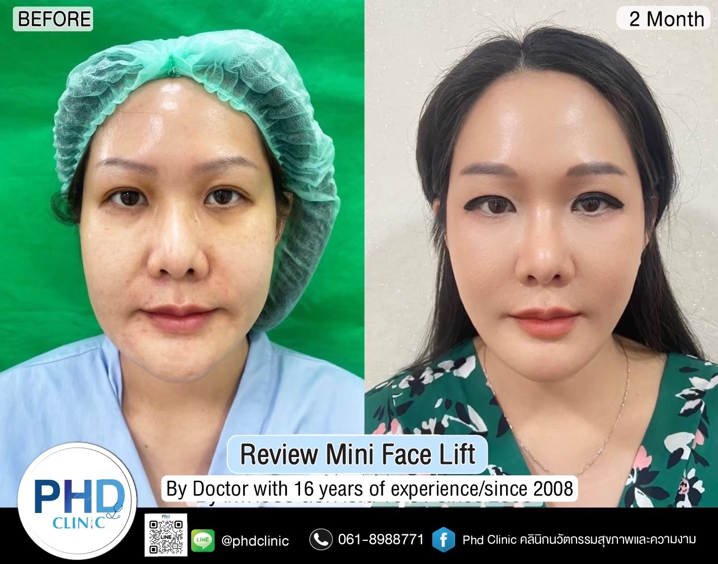 review Facelift Surgery Phuket