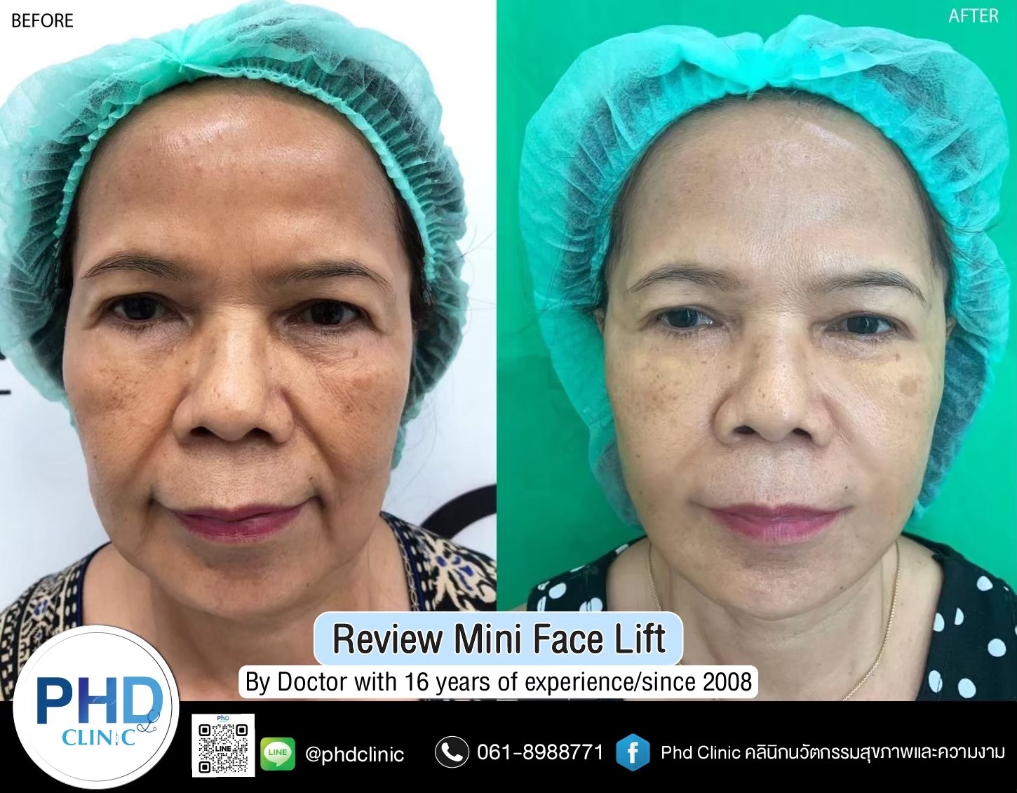 review Facelift Surgery Phuket