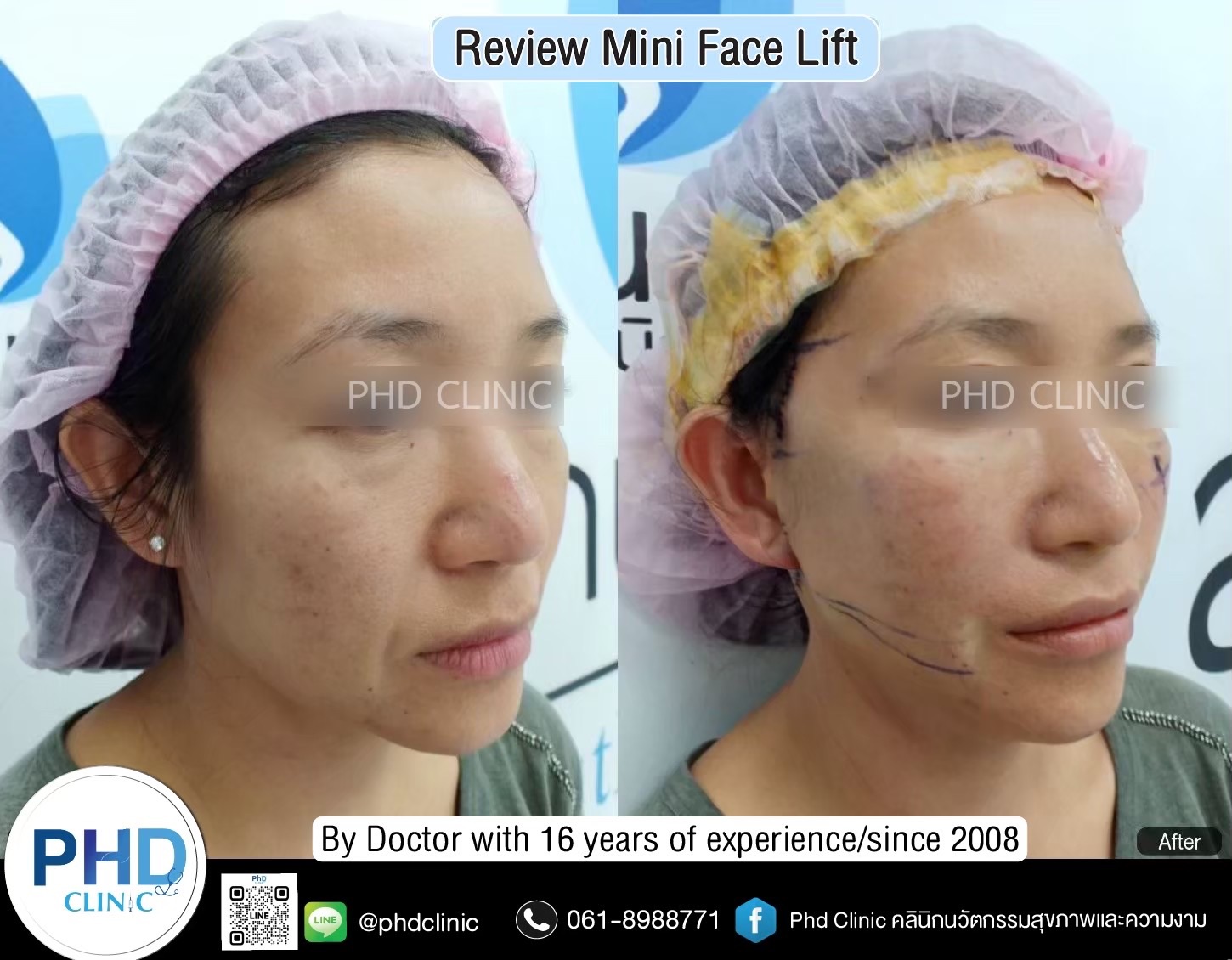 Innovative Procedures Combined with Facelifts (Combination Procedures)