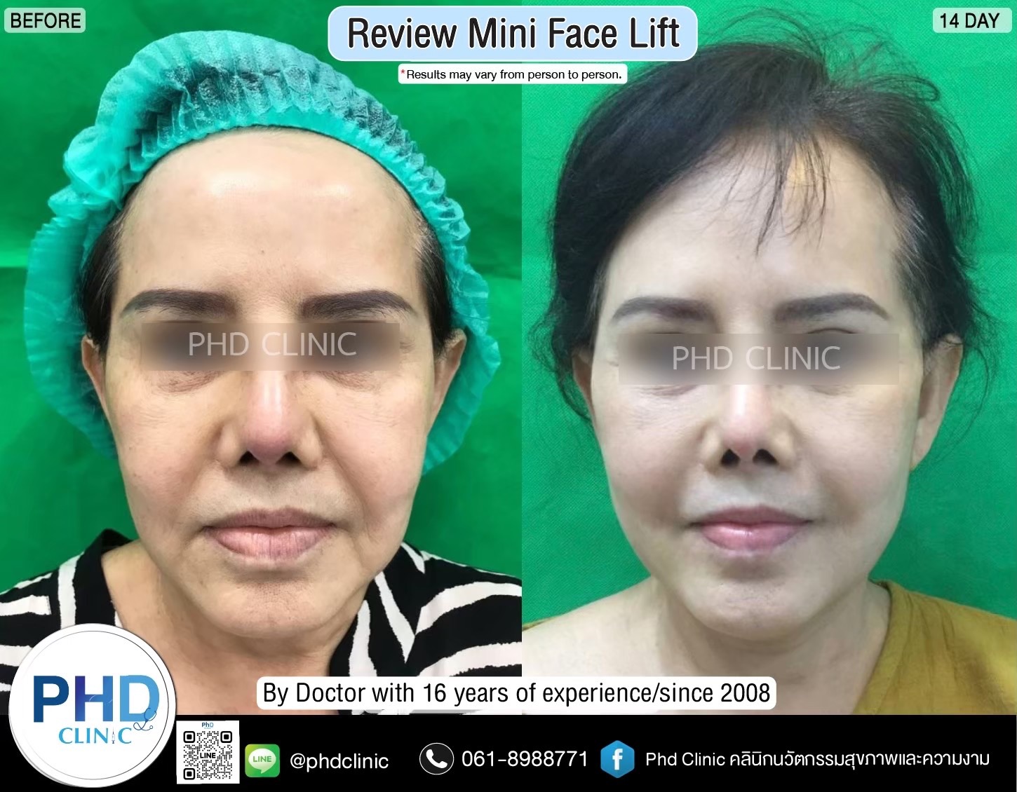 review Facelift Surgery Phuket
