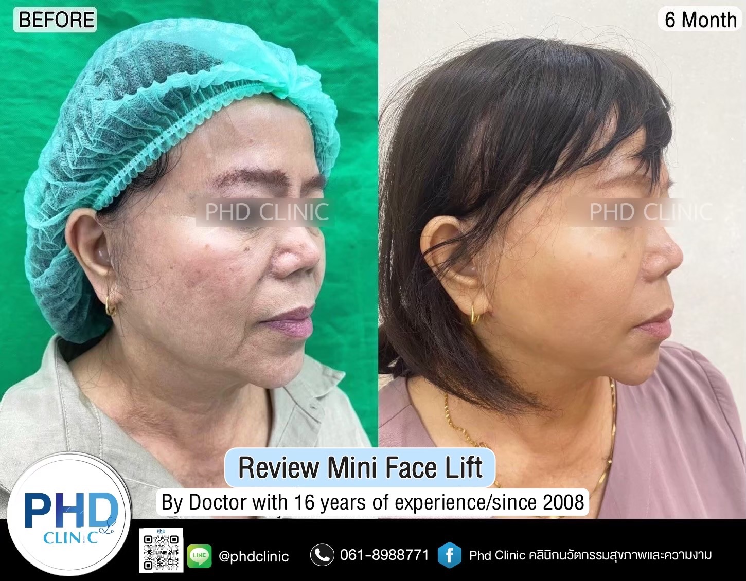 review Facelift Surgery Phuket 2026