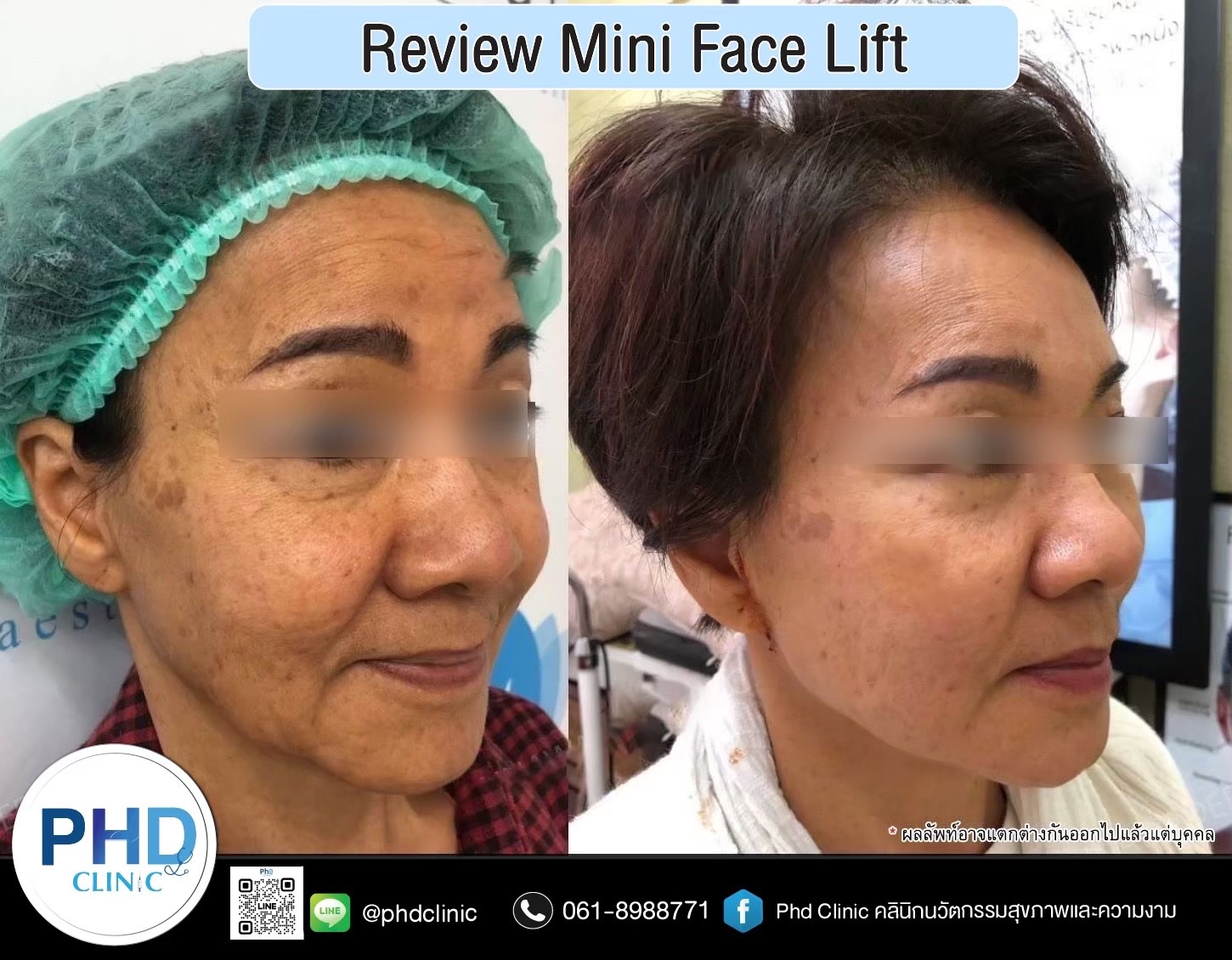 review Facelift Surgery Phuket 2026